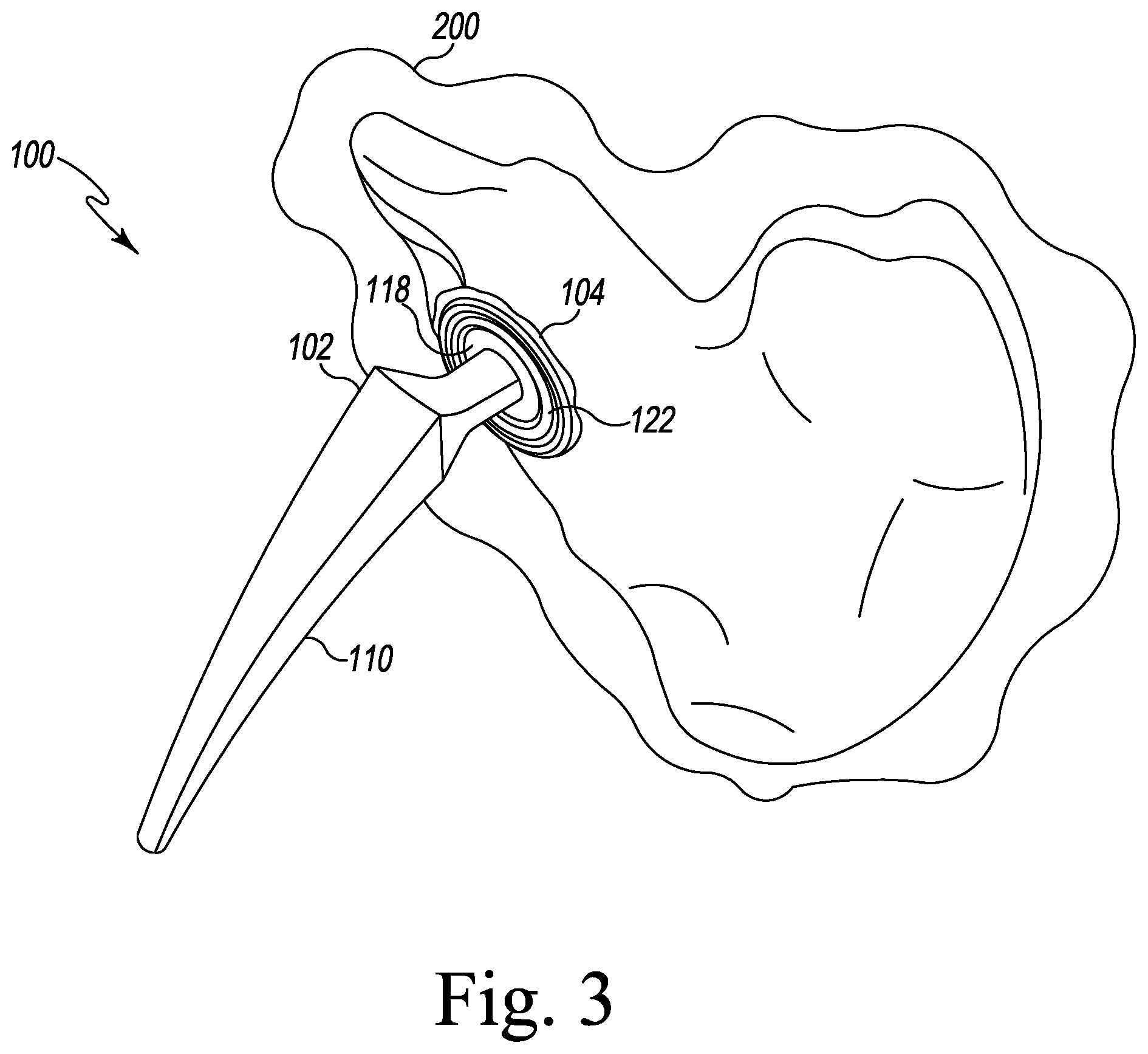 Patent US12611254 Figure 3 – Apparatus, system, and method for determining a position of a hip prosthesis in a bone of a patient