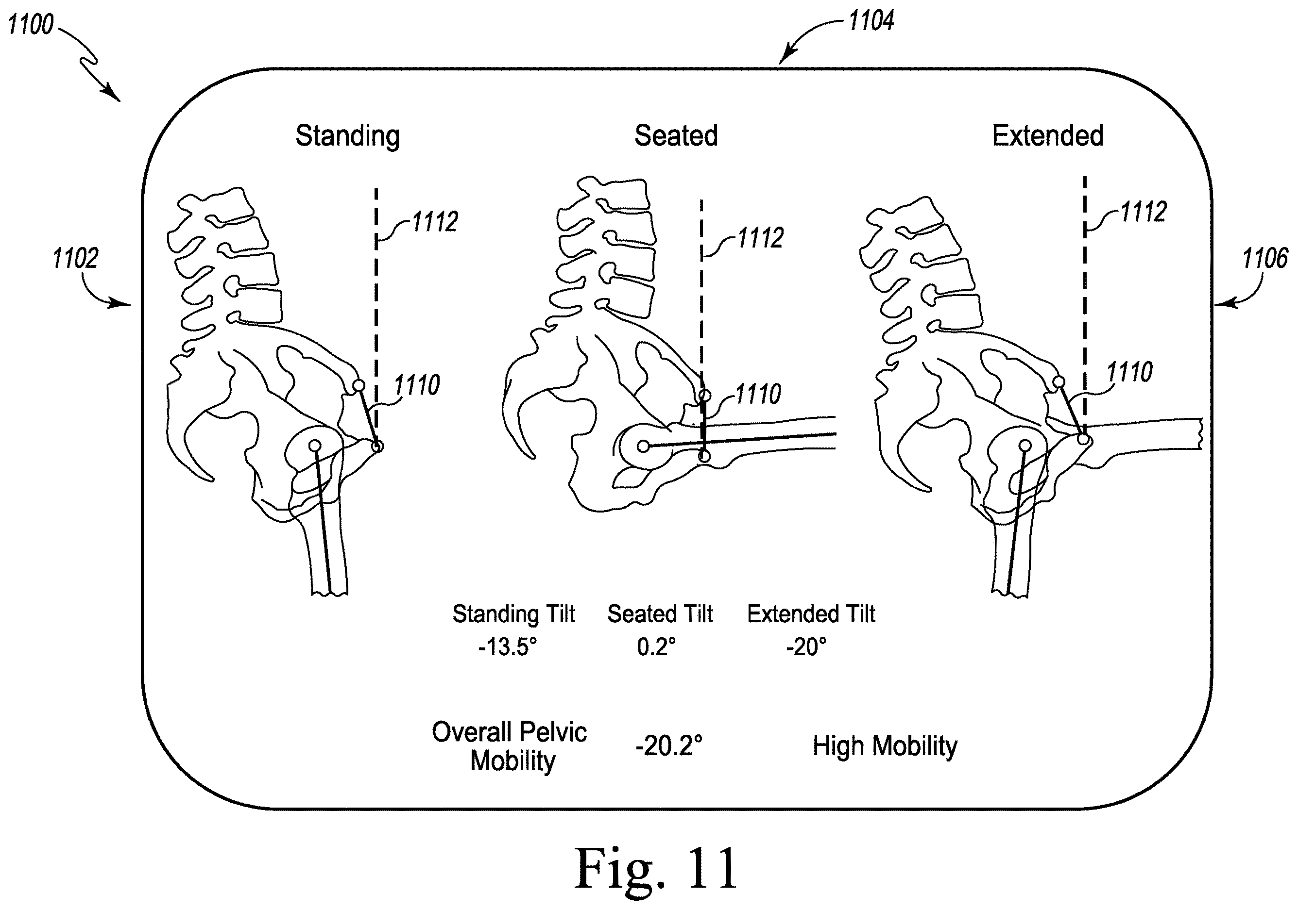 Patent US12611254 Figure 16 – Apparatus, system, and method for determining a position of a hip prosthesis in a bone of a patient