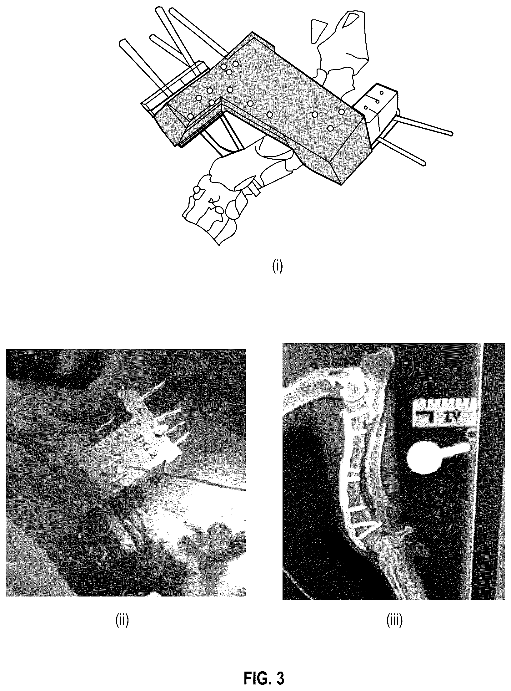 Patent US12611257 Figure 3 – Surgical kits for orthopedic surgery and associated surgical techniques