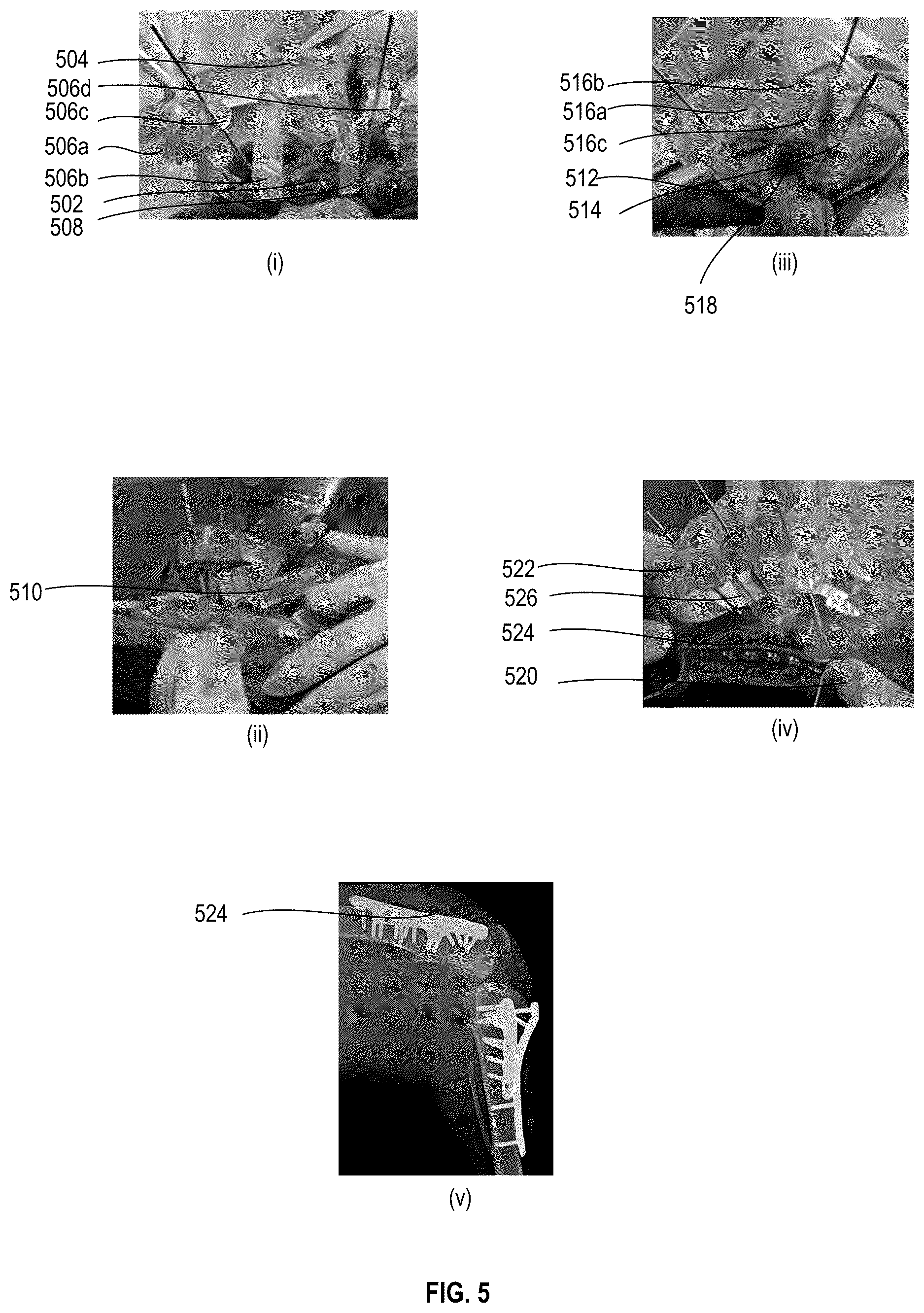 Patent US12611257 Figure 5 – Surgical kits for orthopedic surgery and associated surgical techniques