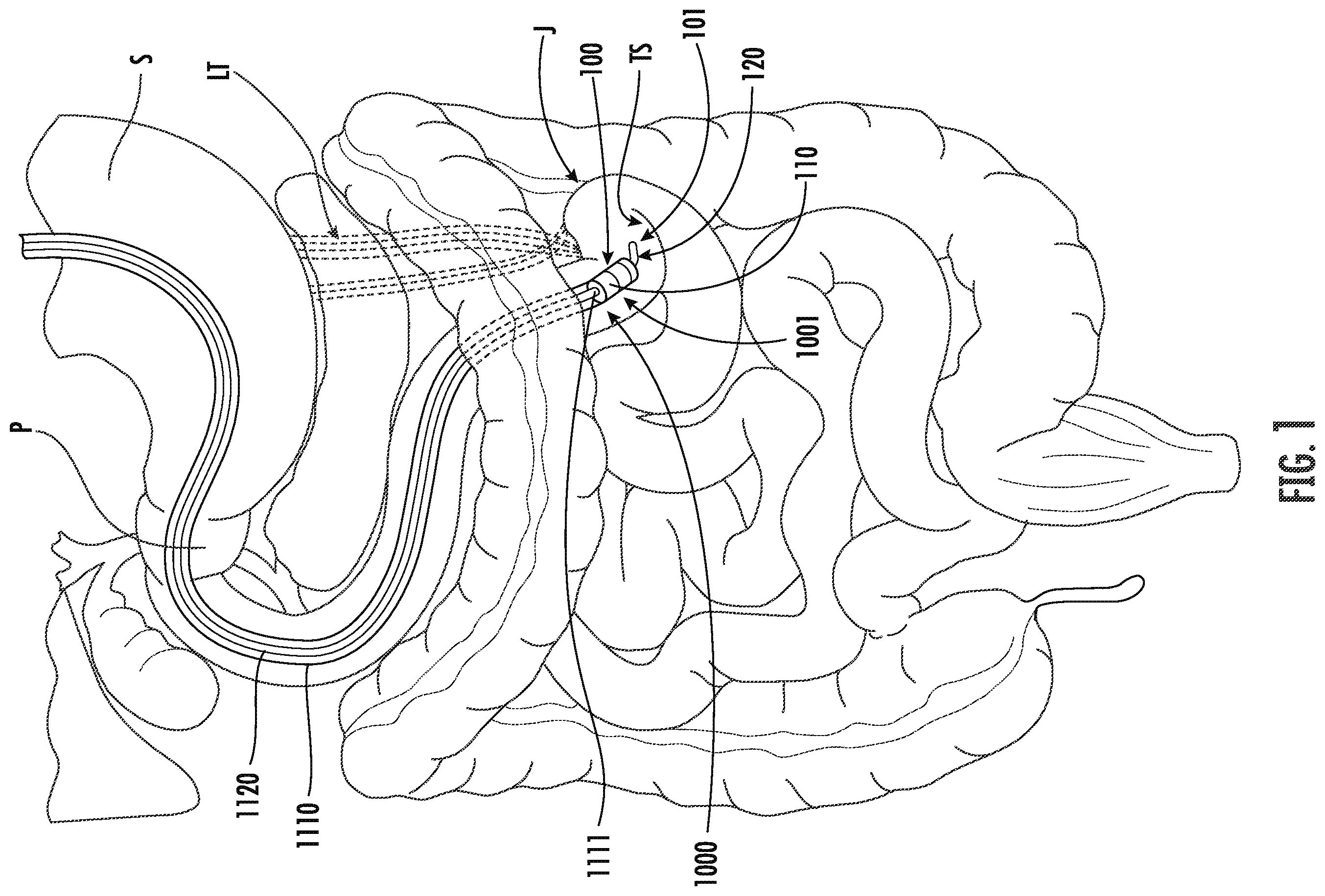 Patent US12611285 Figure 1 – Wireless devices, systems, and methods for endoscopic positioning