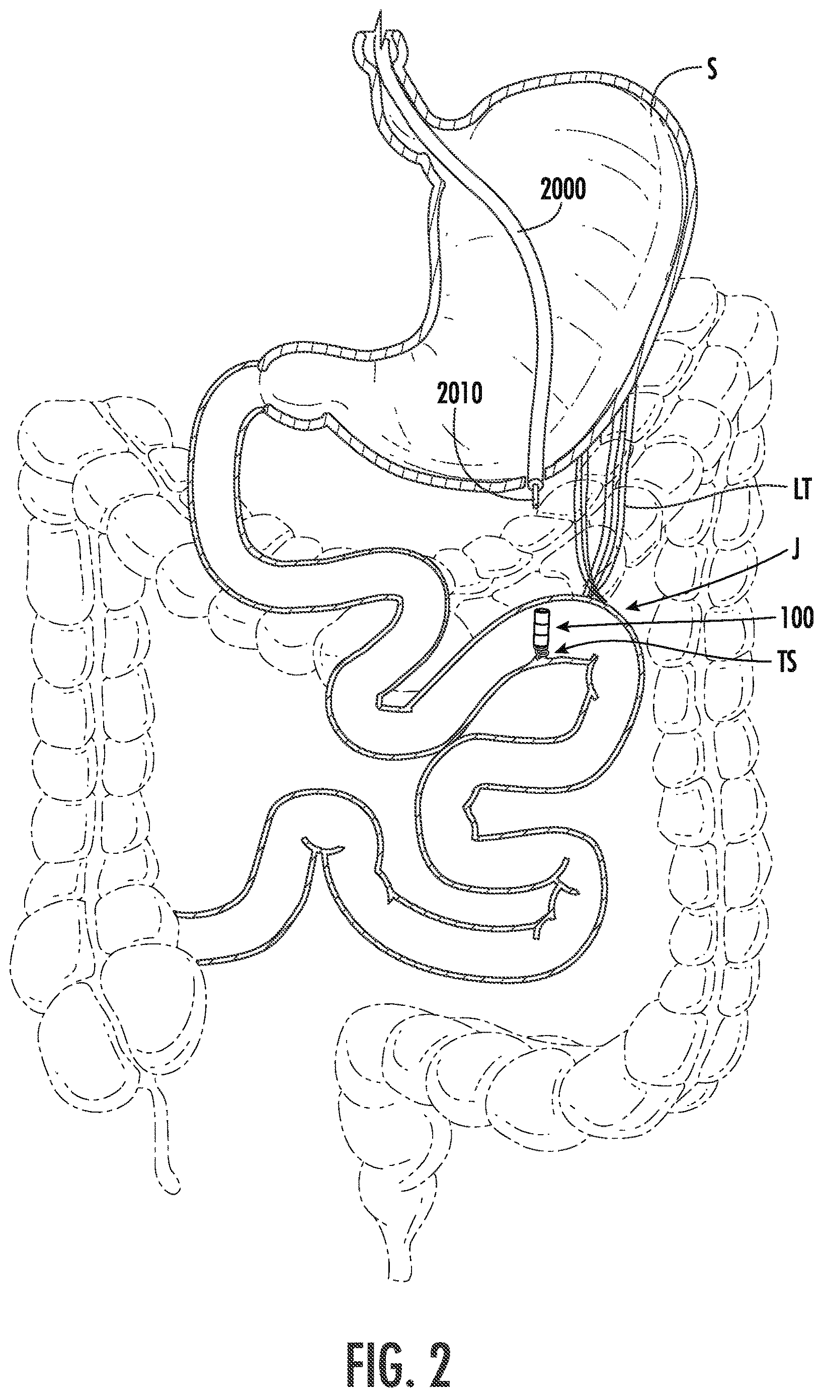 Patent US12611285 Figure 2 – Wireless devices, systems, and methods for endoscopic positioning