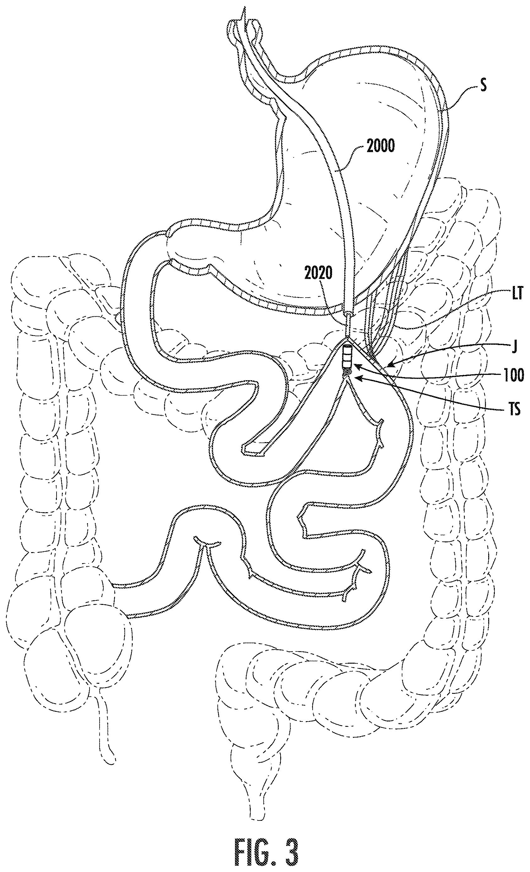 Patent US12611285 Figure 3 – Wireless devices, systems, and methods for endoscopic positioning