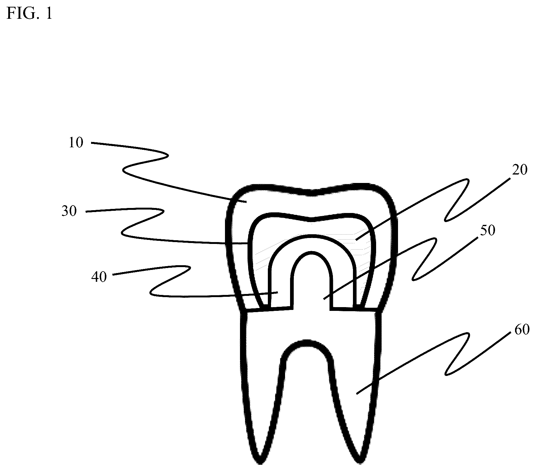Patent US12611286 — Method and apparatus for dental crown restorations using prefabricated sleeve-crown pairs — Figure 1