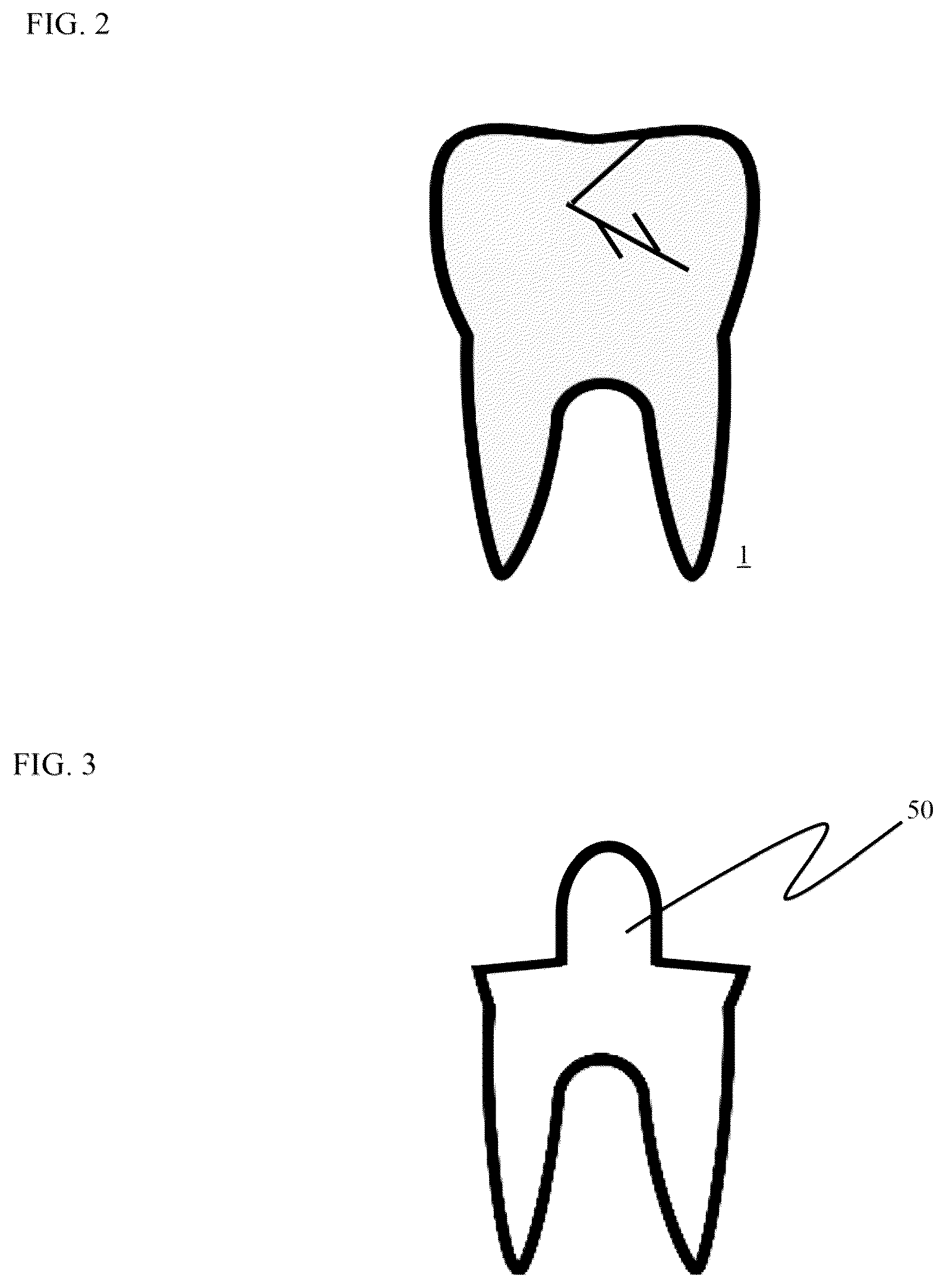 Patent US12611286 Figure 2 – Method and apparatus for dental crown restorations using prefabricated sleeve-crown pairs