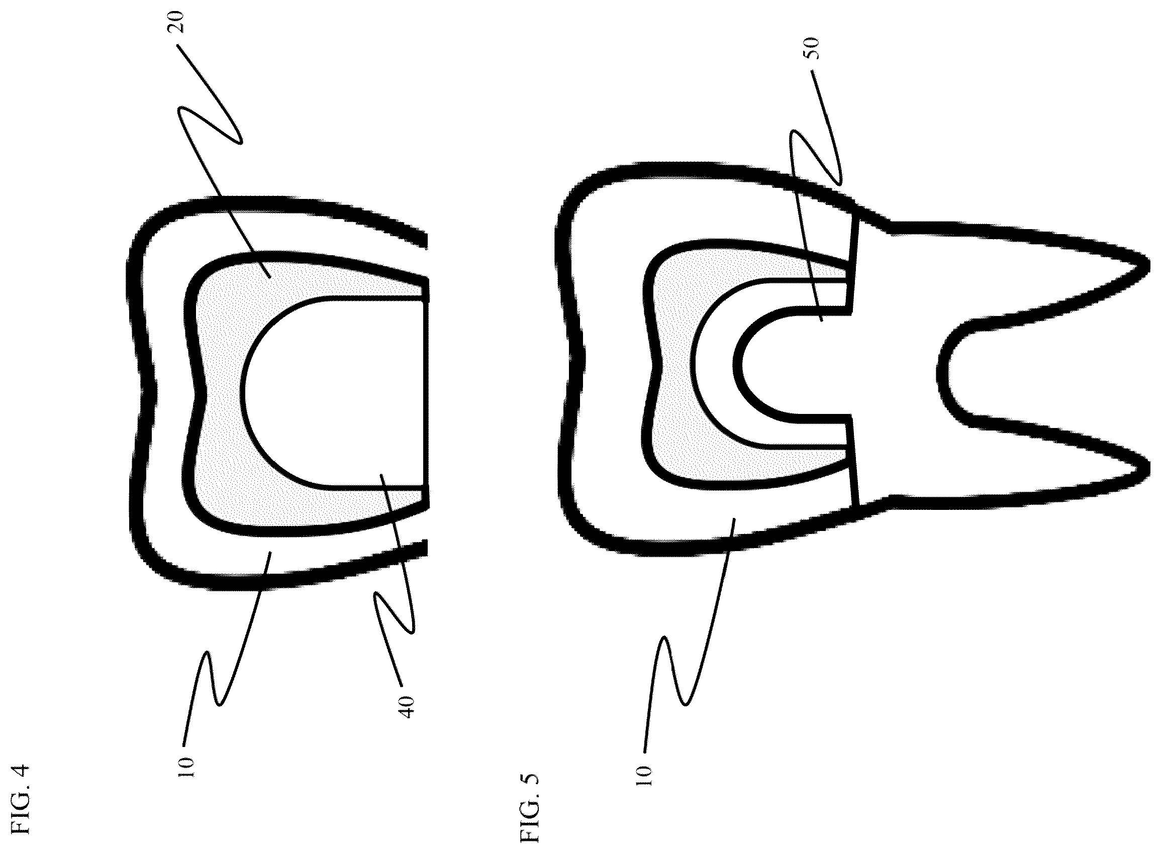 Patent US12611286 Figure 3 – Method and apparatus for dental crown restorations using prefabricated sleeve-crown pairs