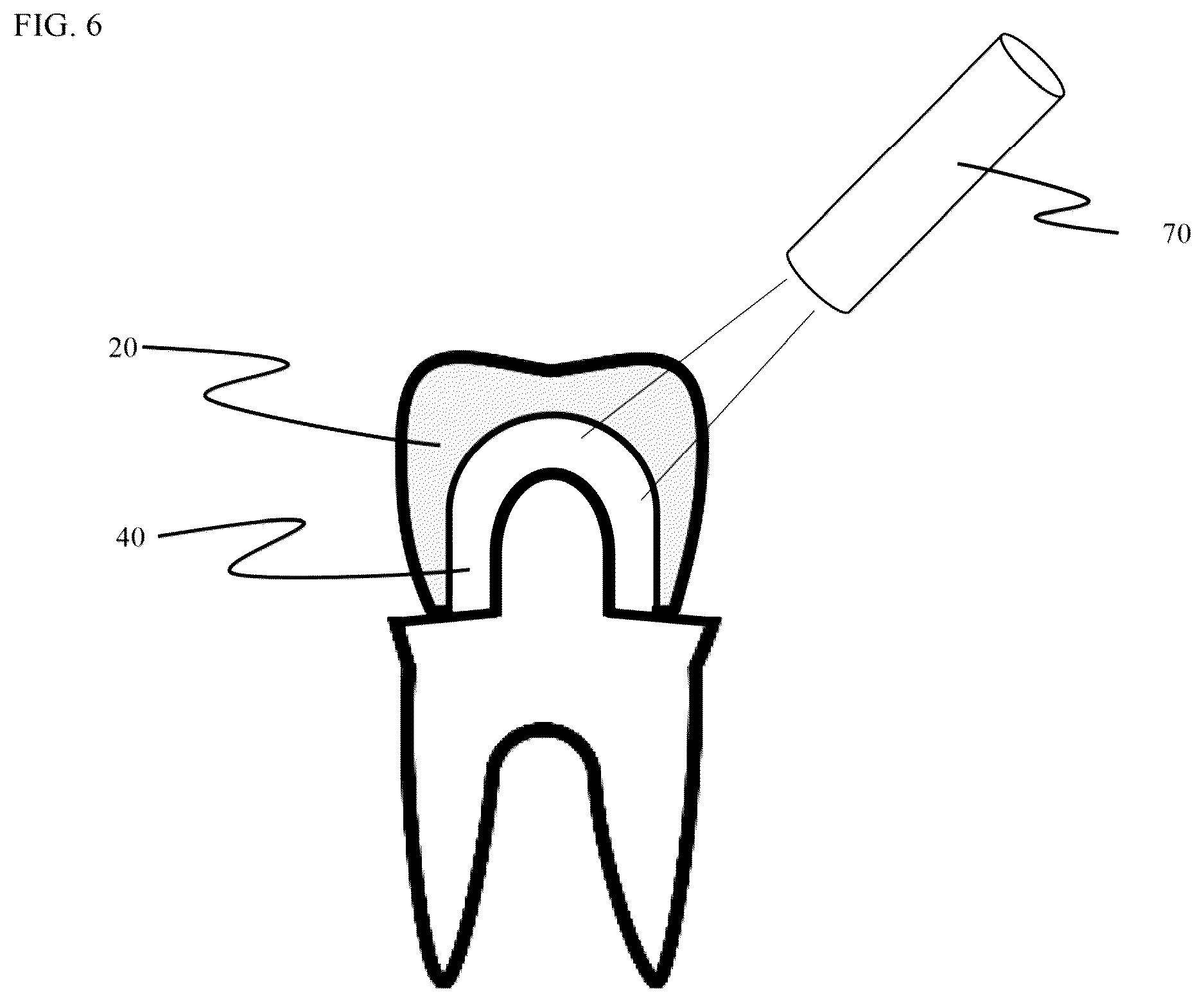 Patent US12611286 Figure 4 – Method and apparatus for dental crown restorations using prefabricated sleeve-crown pairs