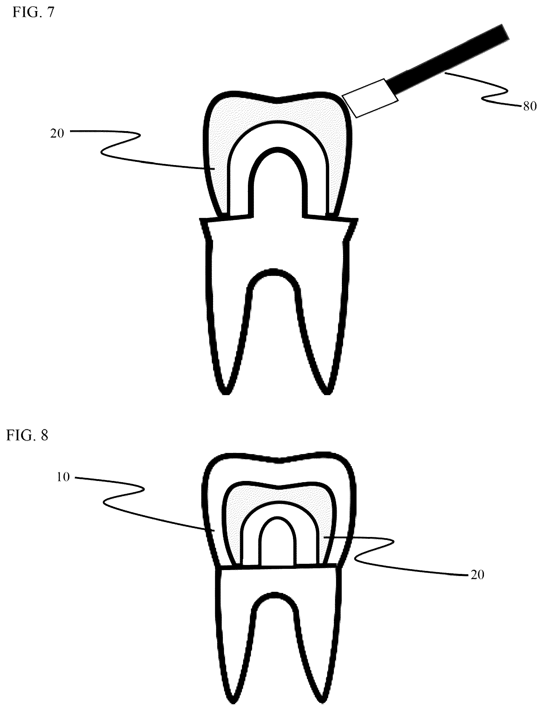Patent US12611286 Figure 5 – Method and apparatus for dental crown restorations using prefabricated sleeve-crown pairs