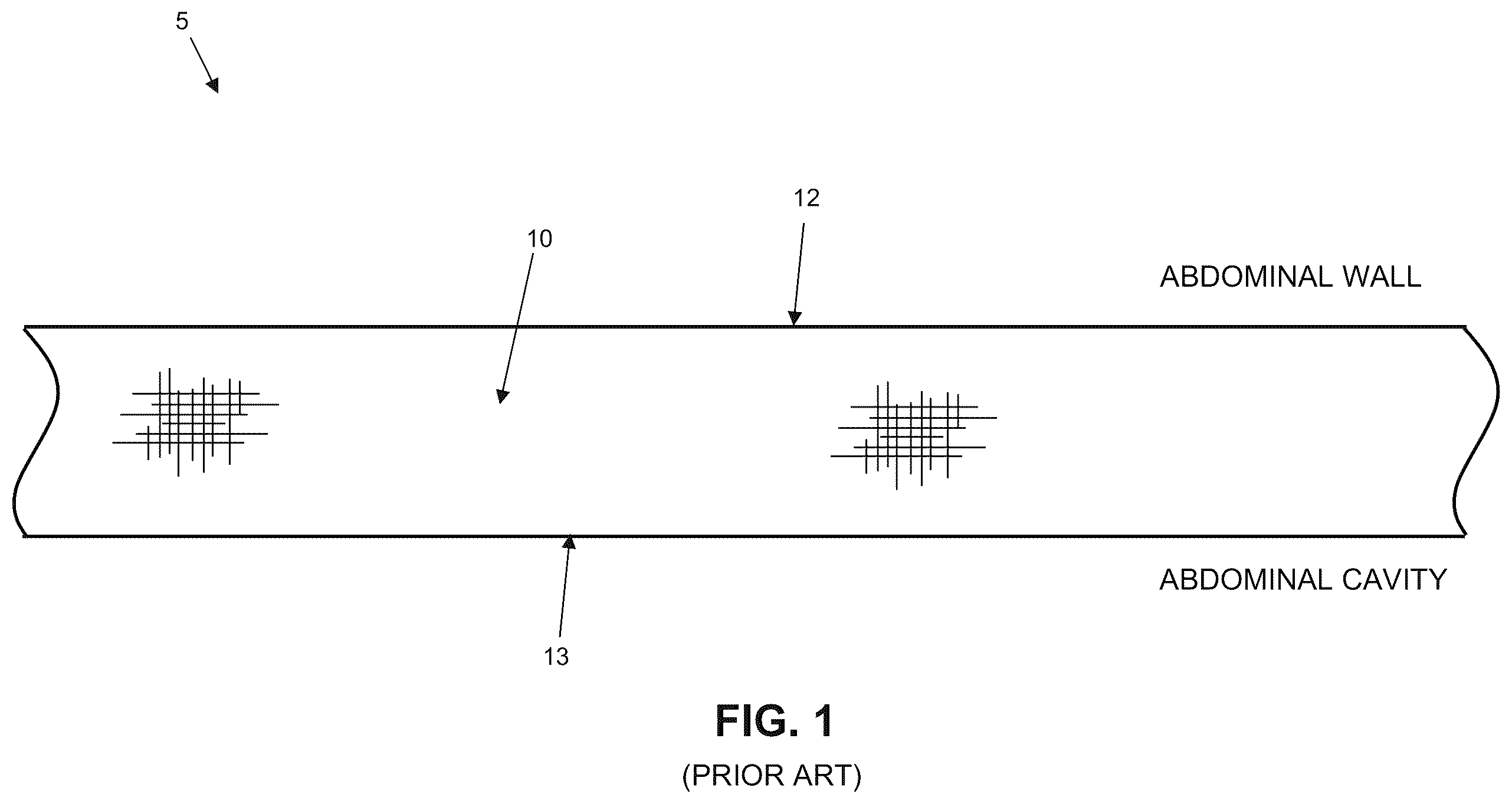 Patent US12611293 — Surgical mesh having ingrowth-preventing coating on one side thereof, and method for making the same — Figure 1