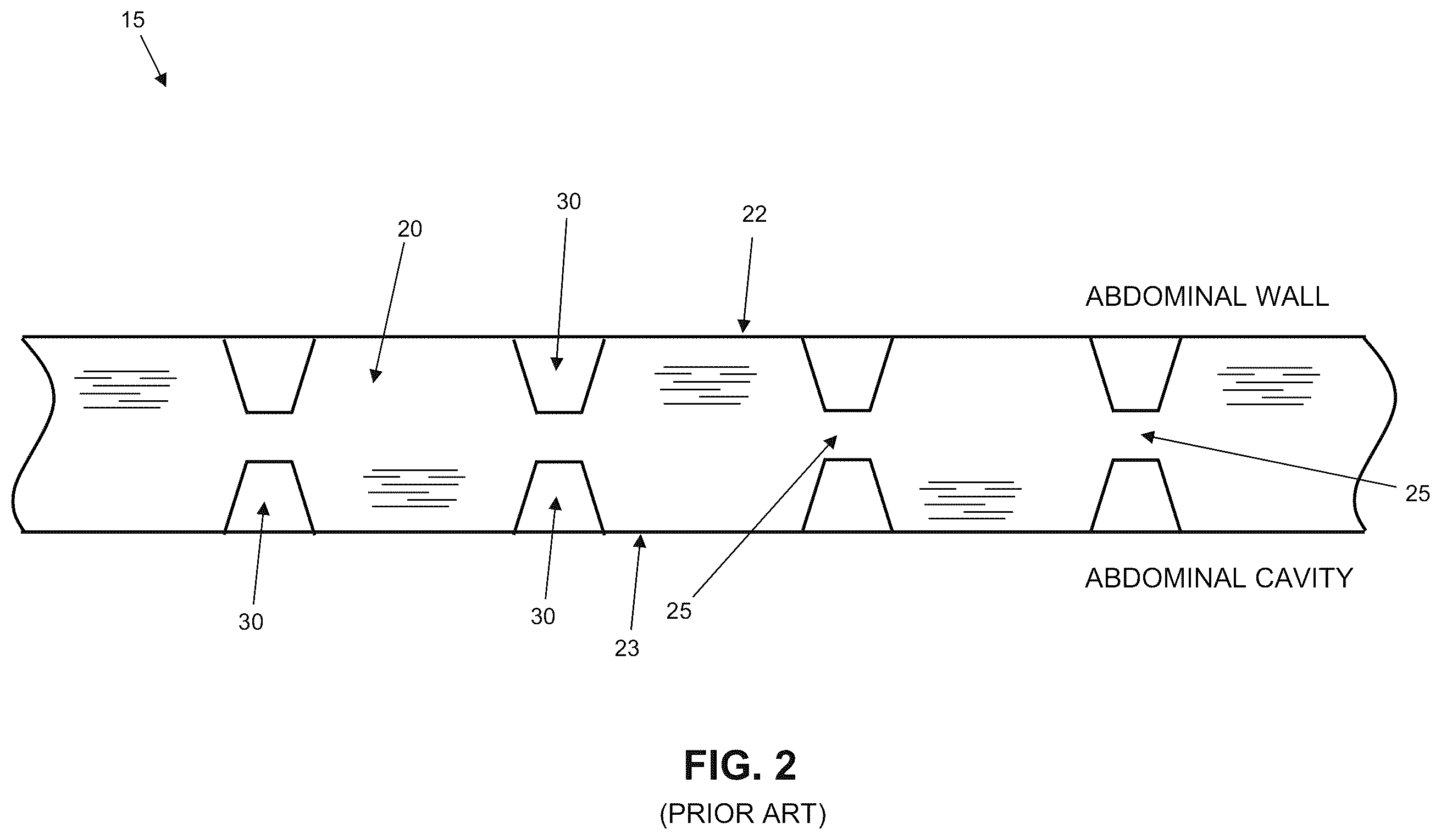 Patent US12611293 Figure 2 – Surgical mesh having ingrowth-preventing coating on one side thereof, and method for making the same