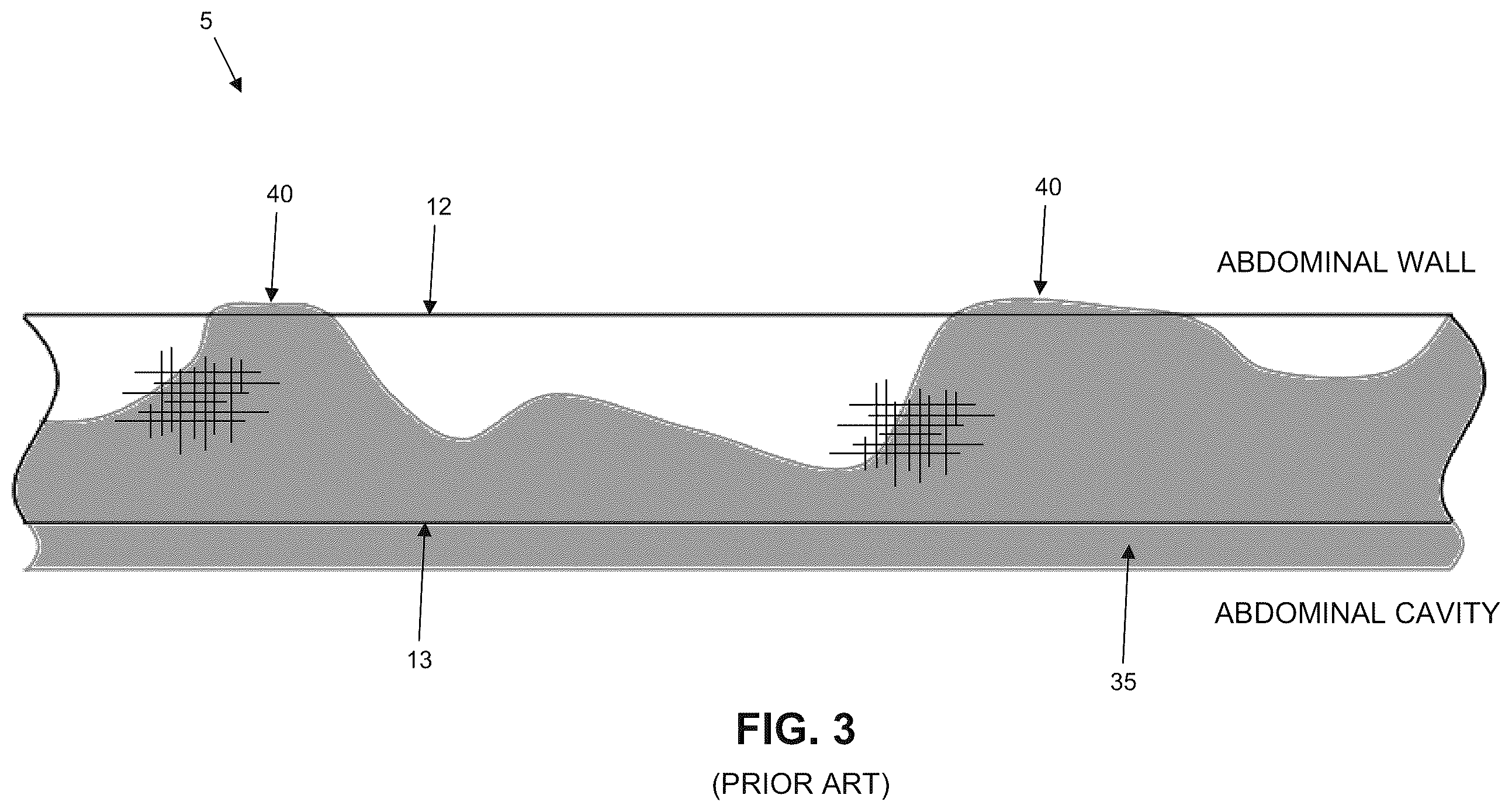 Patent US12611293 Figure 3 – Surgical mesh having ingrowth-preventing coating on one side thereof, and method for making the same