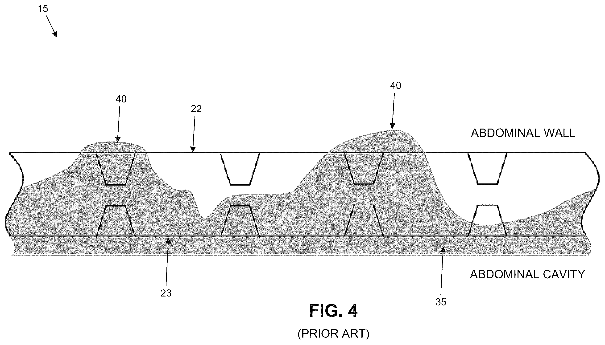 Patent US12611293 Figure 4 – Surgical mesh having ingrowth-preventing coating on one side thereof, and method for making the same