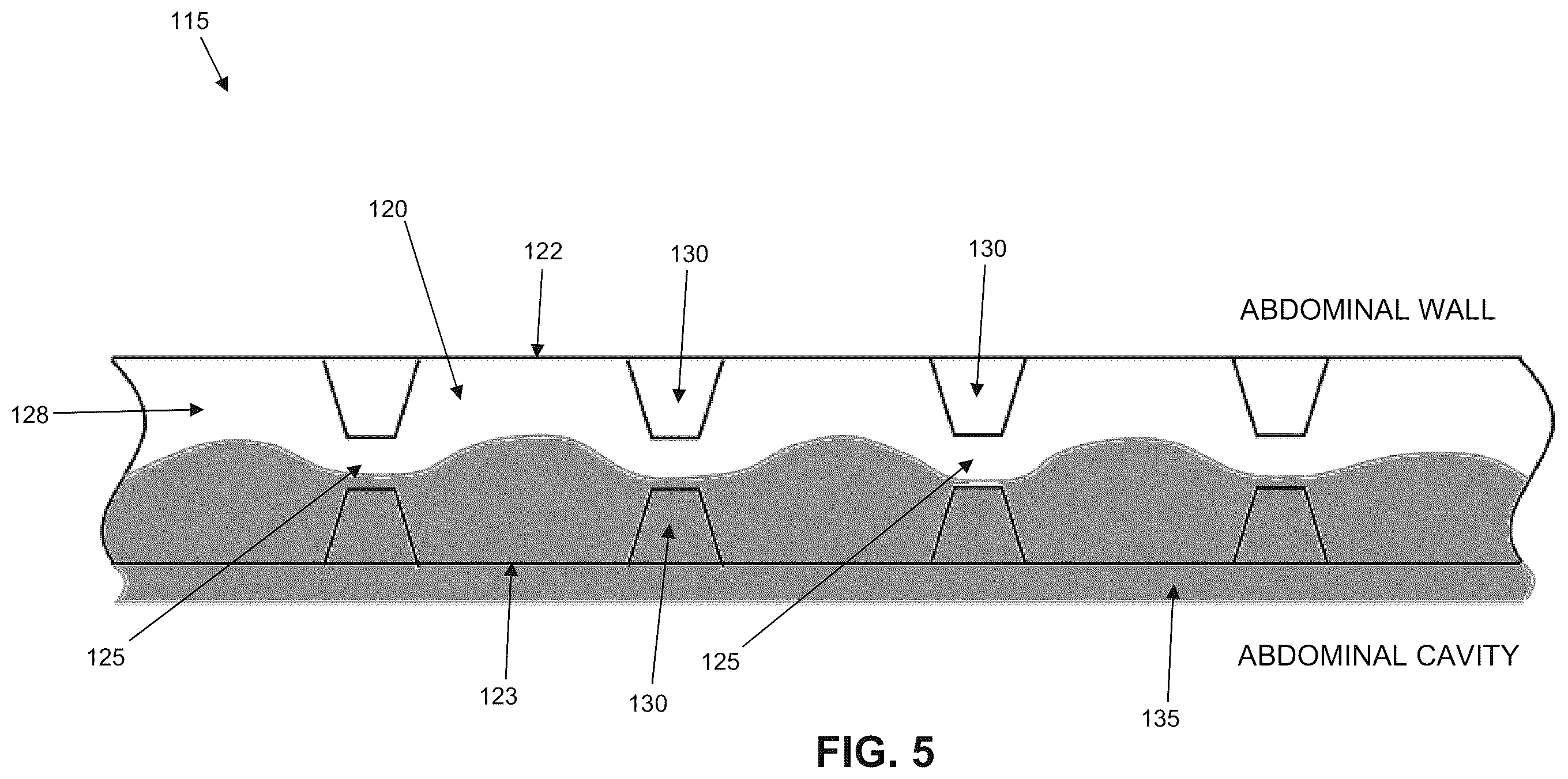 Patent US12611293 Figure 5 – Surgical mesh having ingrowth-preventing coating on one side thereof, and method for making the same