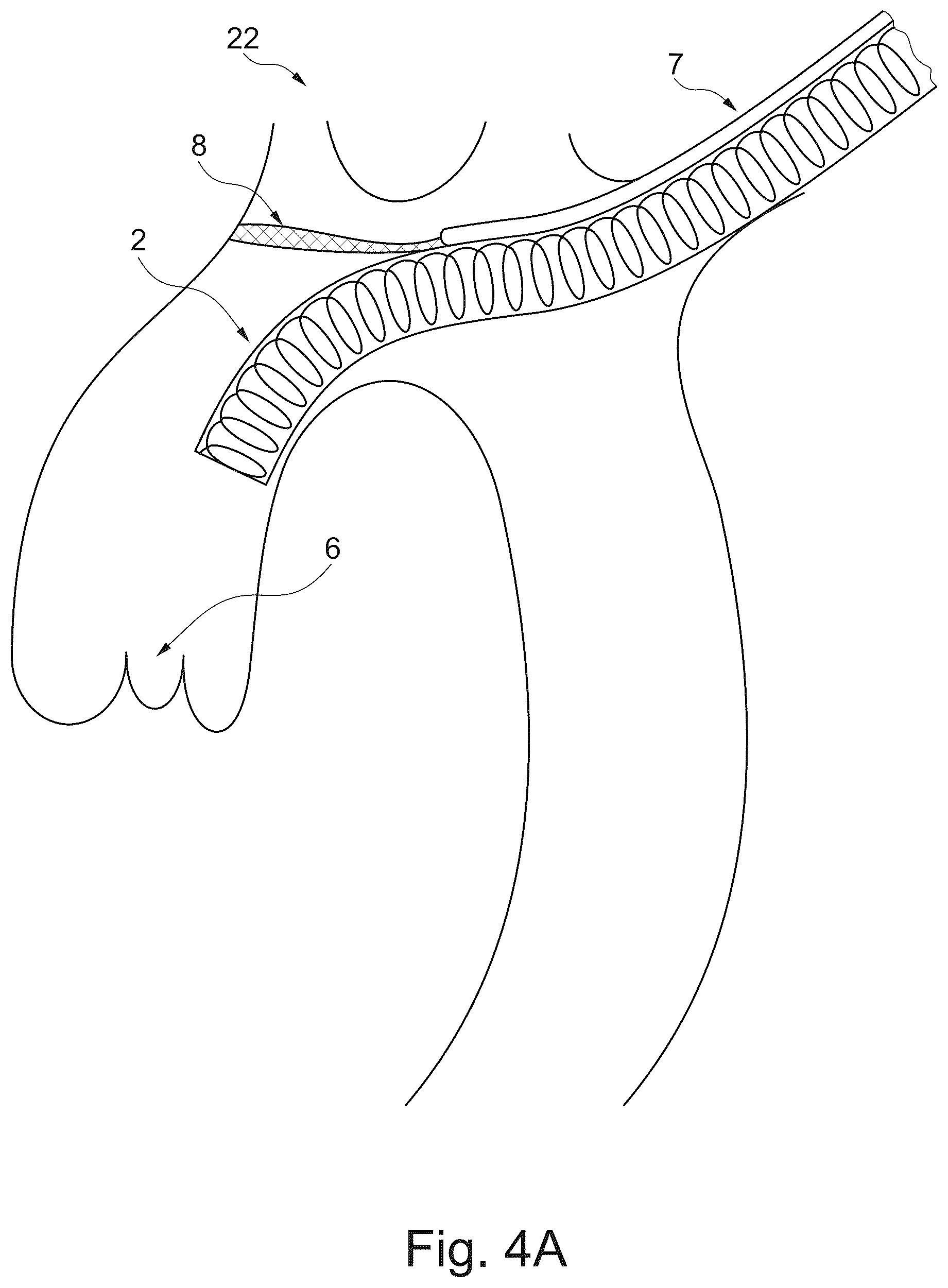 Patent US12611294 Figure 5 – Device and method for delivery of medical devices to a cardiac valve