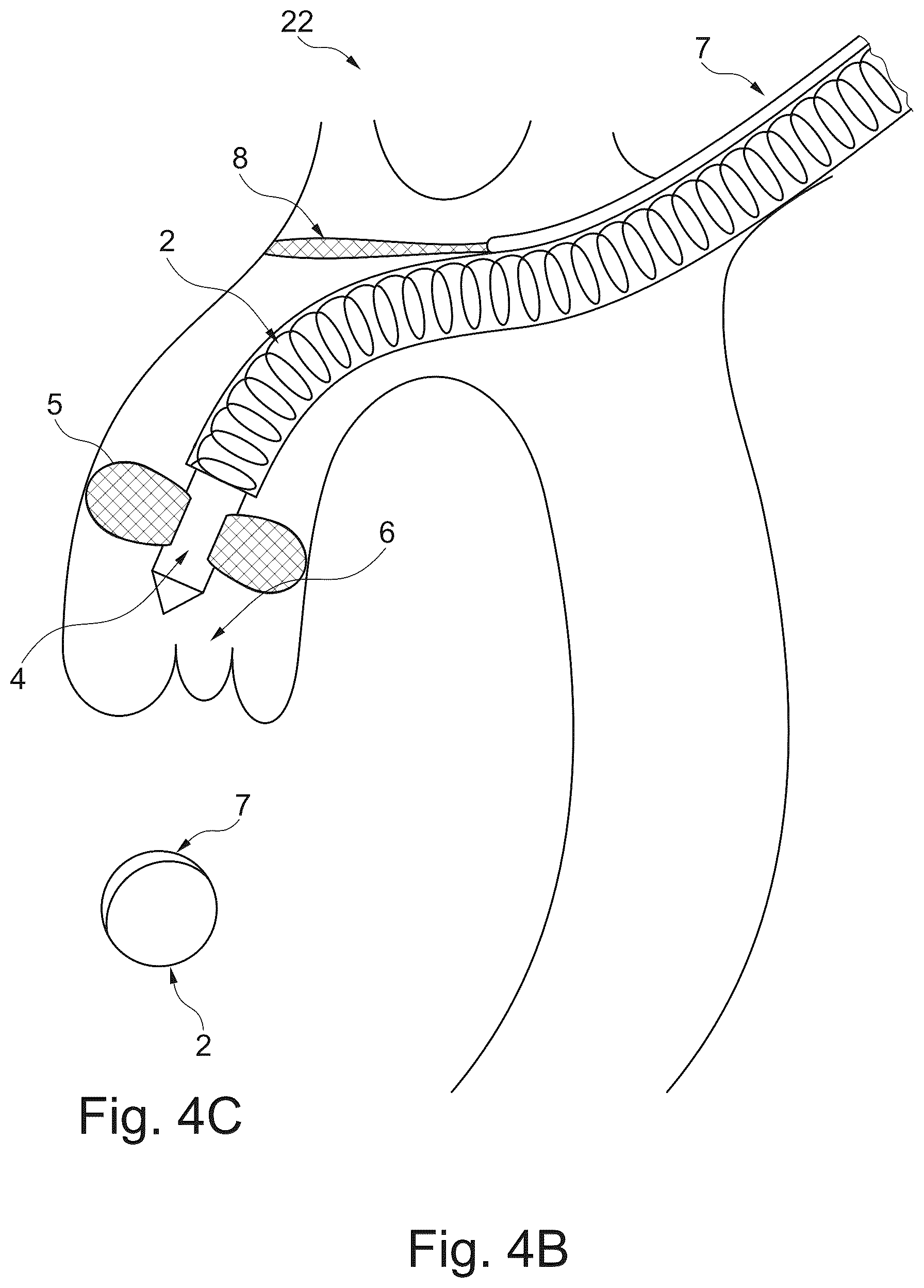 Patent US12611294 Figure 6 – Device and method for delivery of medical devices to a cardiac valve