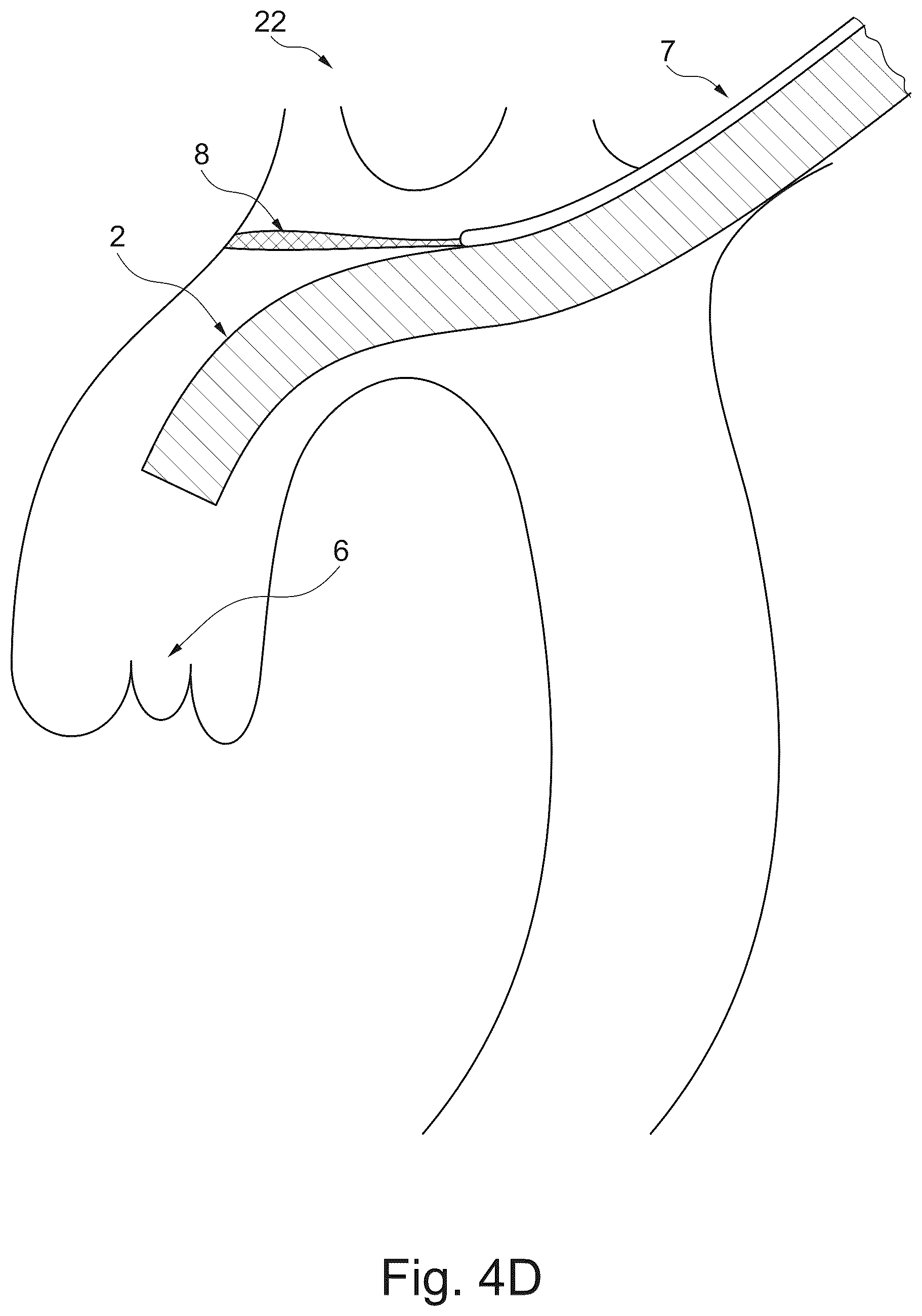 Patent US12611294 Figure 7 – Device and method for delivery of medical devices to a cardiac valve