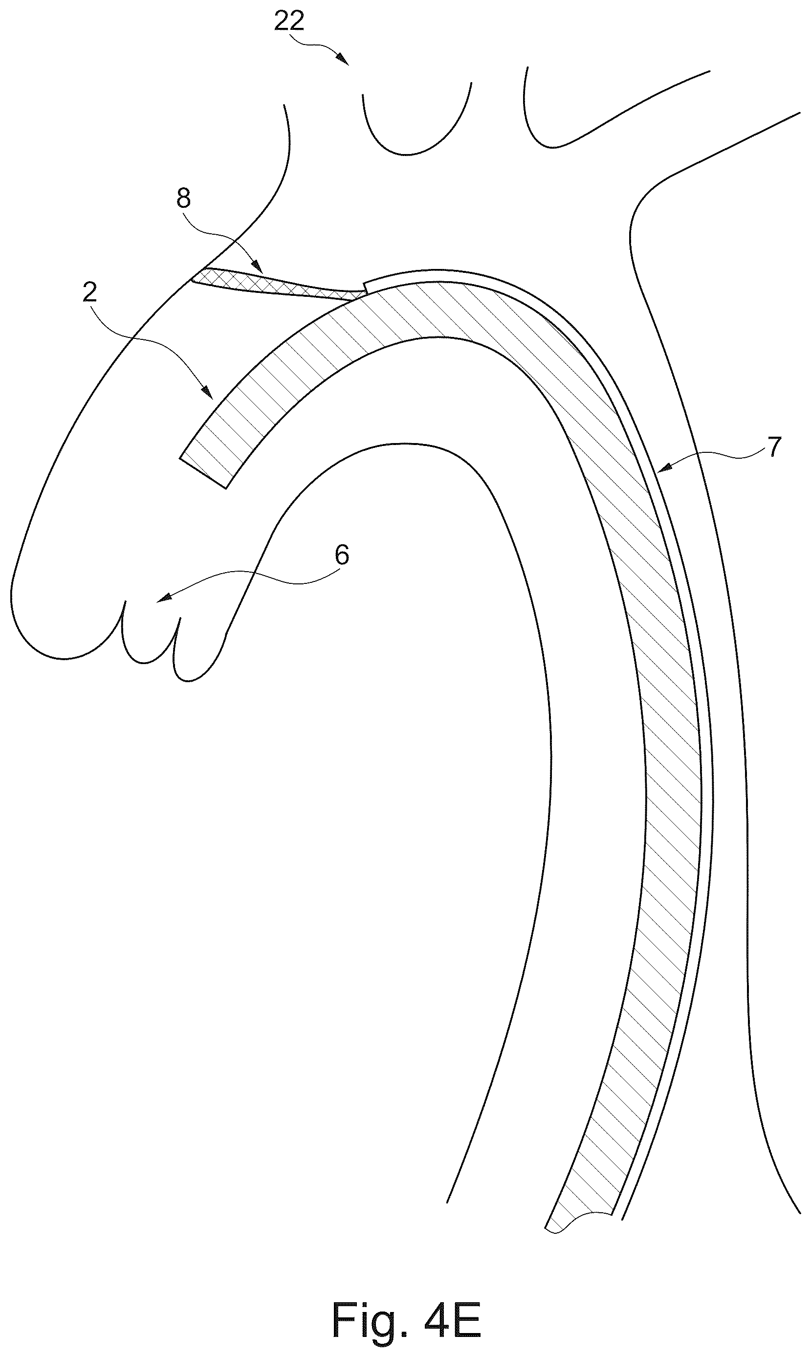 Patent US12611294 Figure 8 – Device and method for delivery of medical devices to a cardiac valve