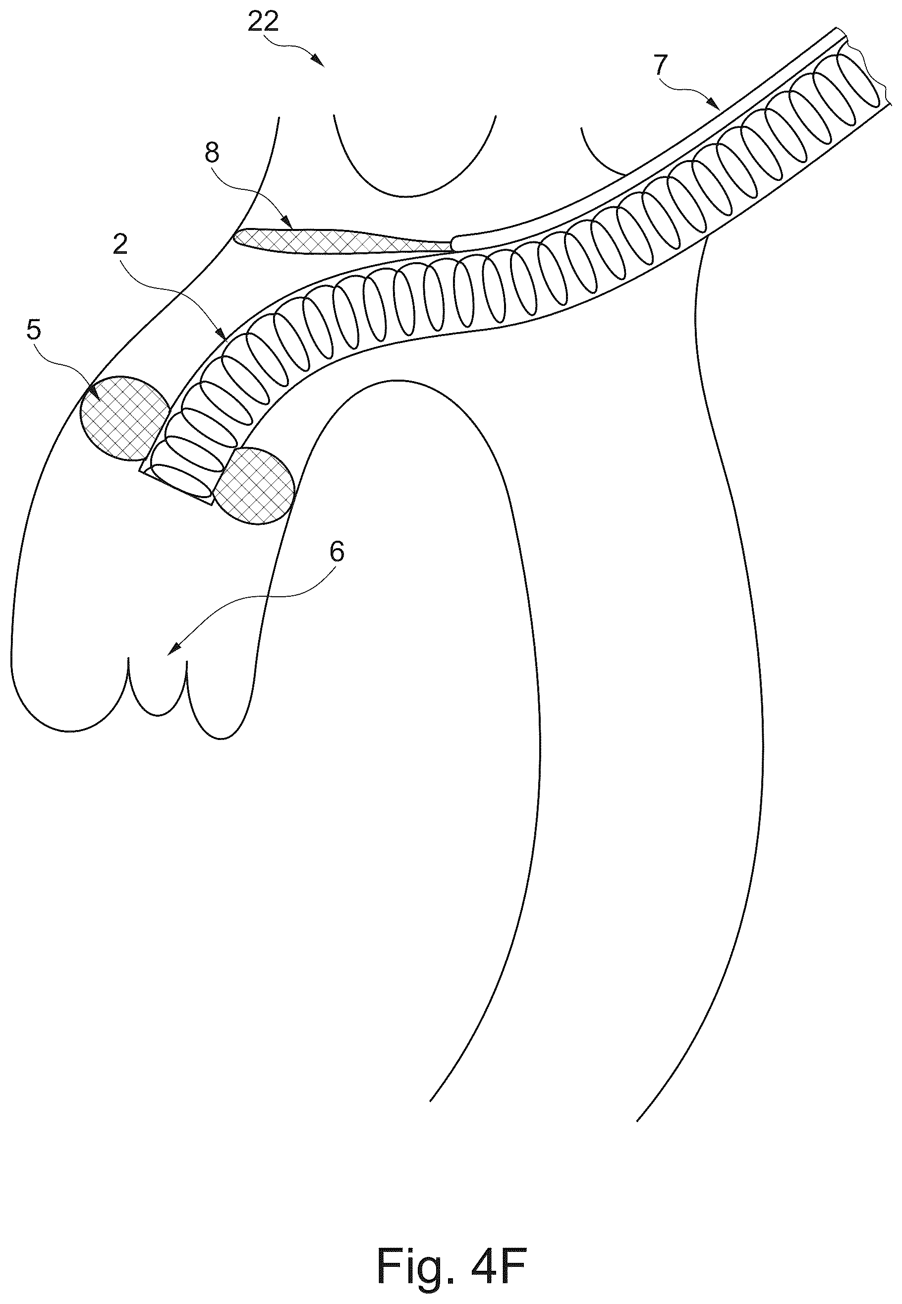 Patent US12611294 Figure 9 – Device and method for delivery of medical devices to a cardiac valve