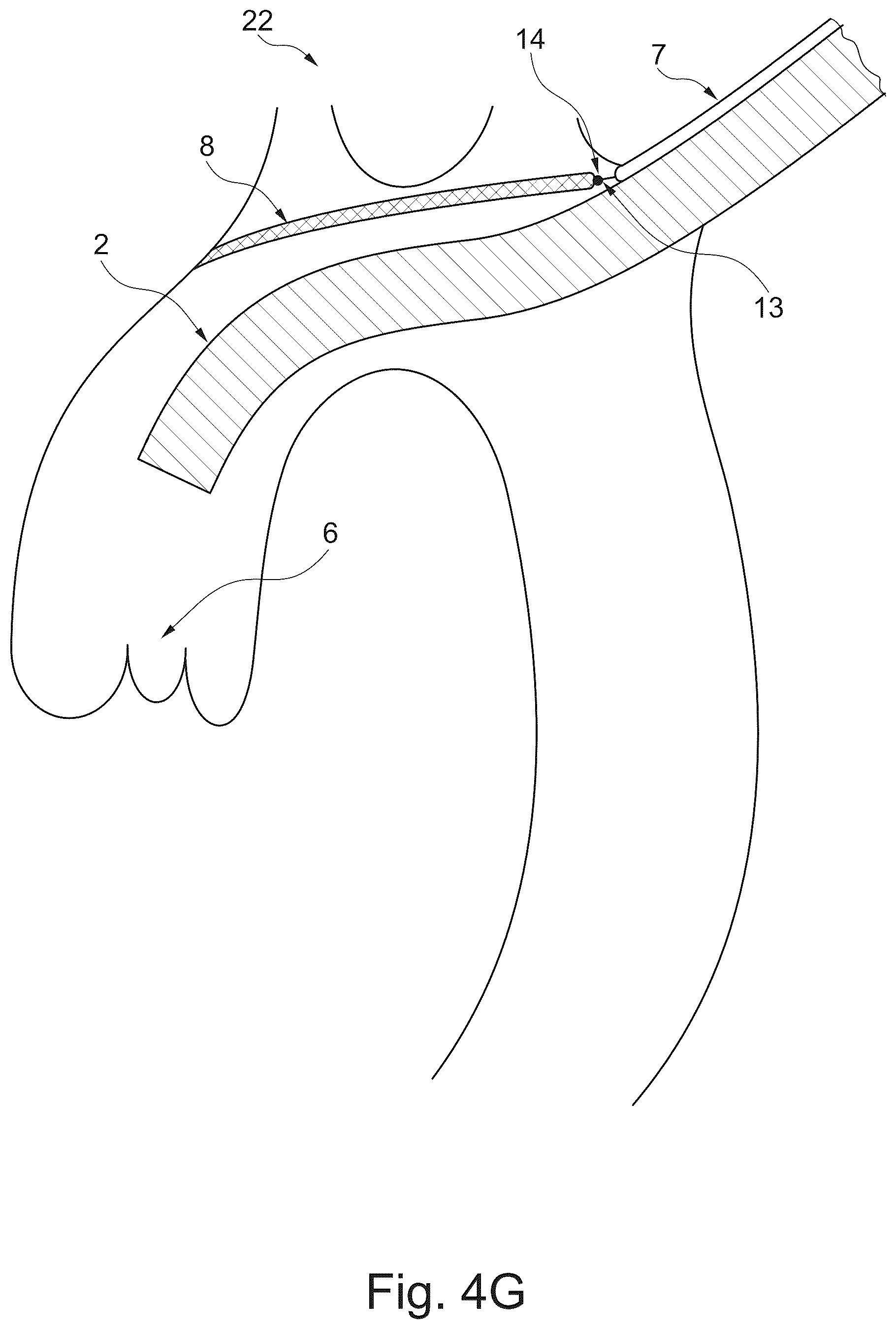Patent US12611294 Figure 10 – Device and method for delivery of medical devices to a cardiac valve