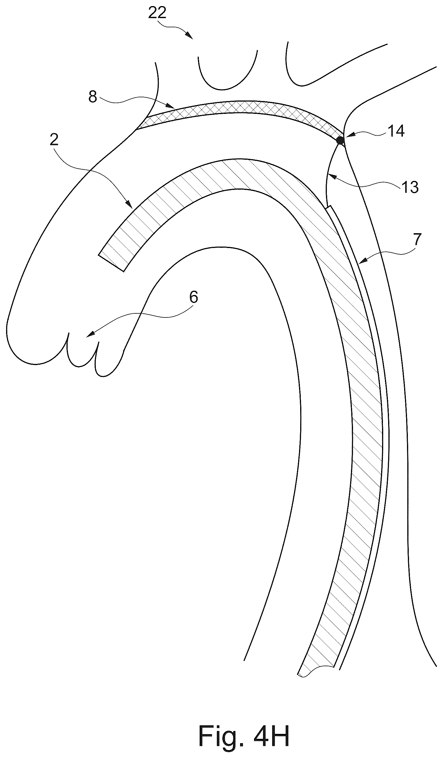 Patent US12611294 Figure 11 – Device and method for delivery of medical devices to a cardiac valve