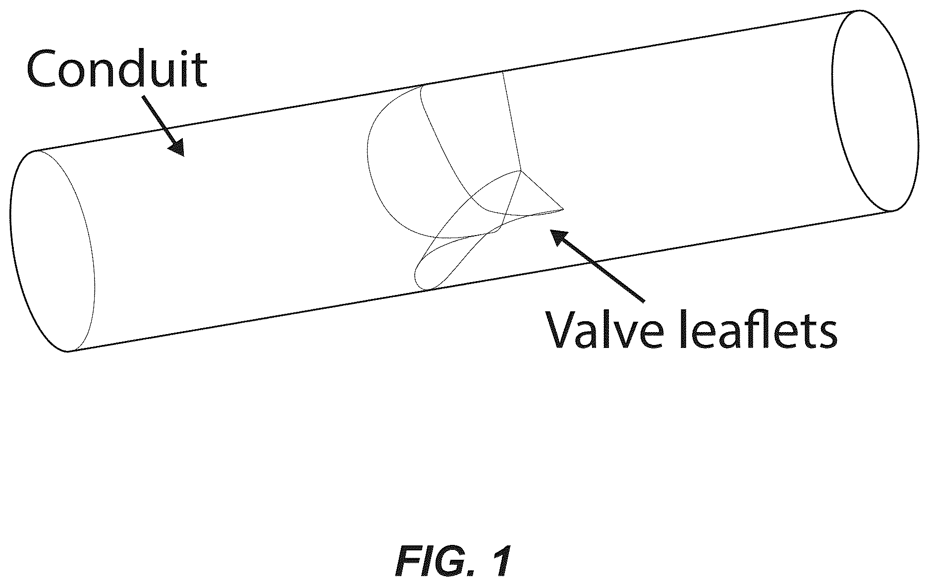 Patent US12611299 — Transcatheter dilatable biostable polymeric stented valved tube prosthesis — Figure 1