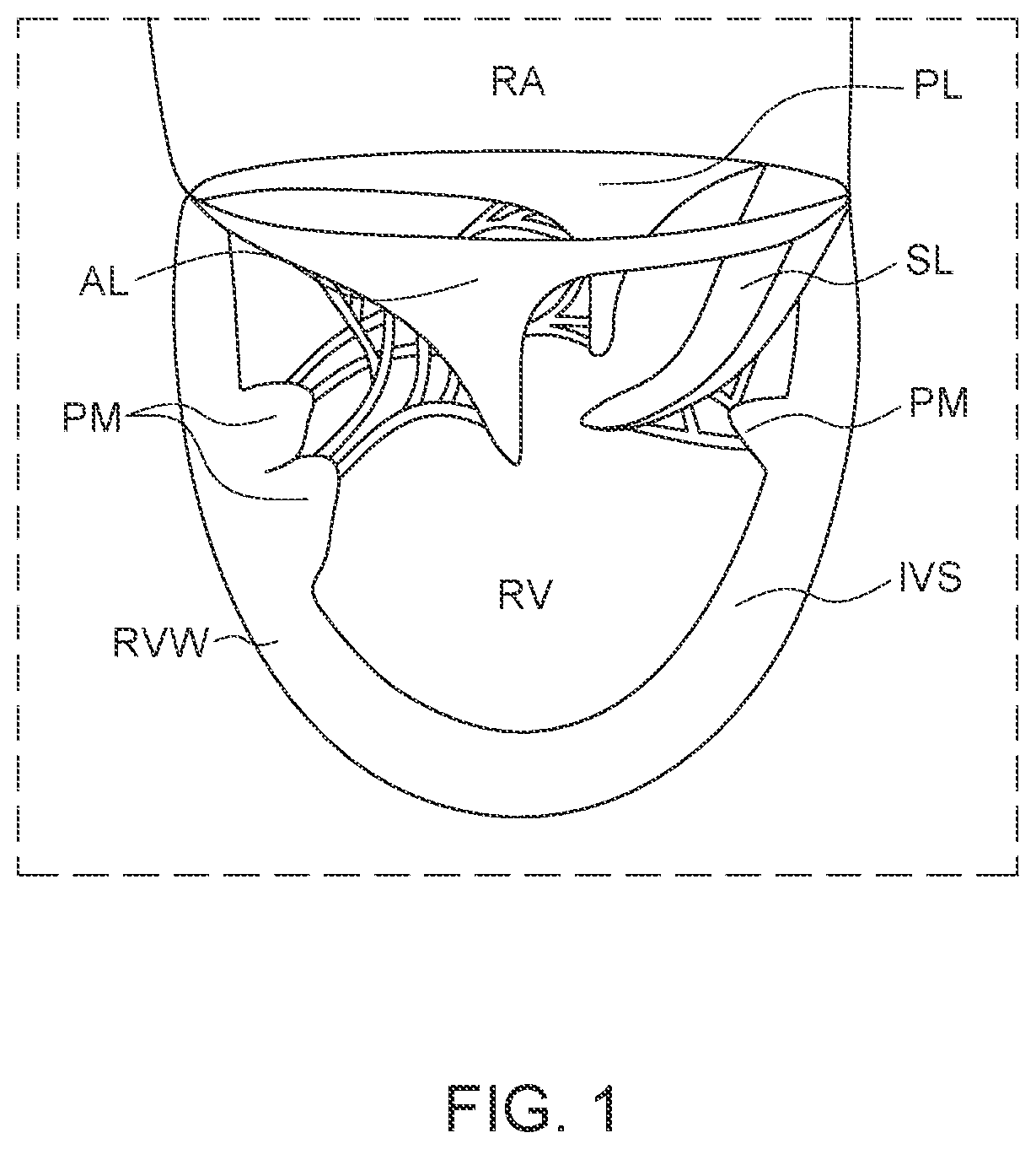 Patent US12611300 — Transcatheter prosthetic atrioventricular valve — Figure 1
