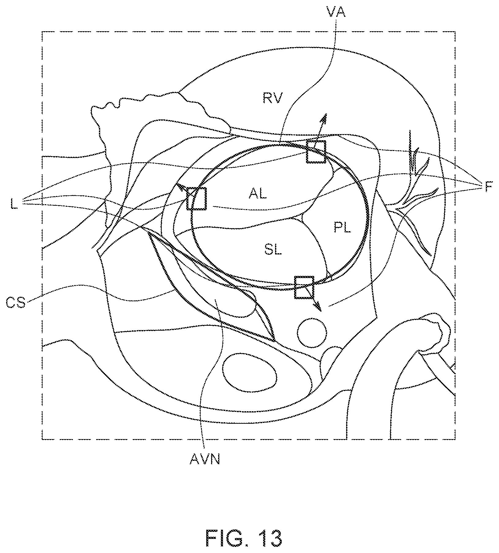 Patent US12611300 Figure 13 – Transcatheter prosthetic atrioventricular valve