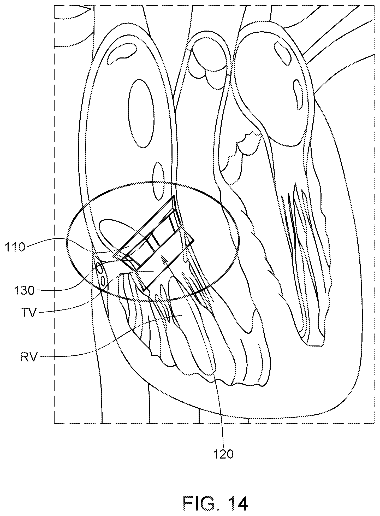 Patent US12611300 Figure 14 – Transcatheter prosthetic atrioventricular valve