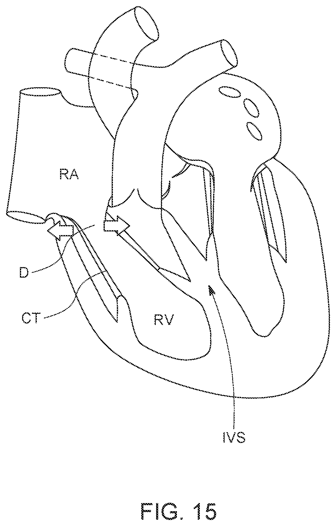 Patent US12611300 Figure 15 – Transcatheter prosthetic atrioventricular valve