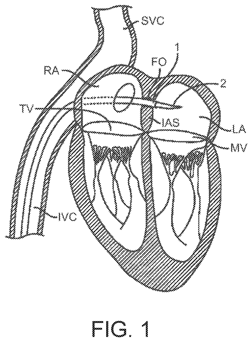Patent US12611302 Figure 1 – Prosthetic heart valve device and associated systems and methods