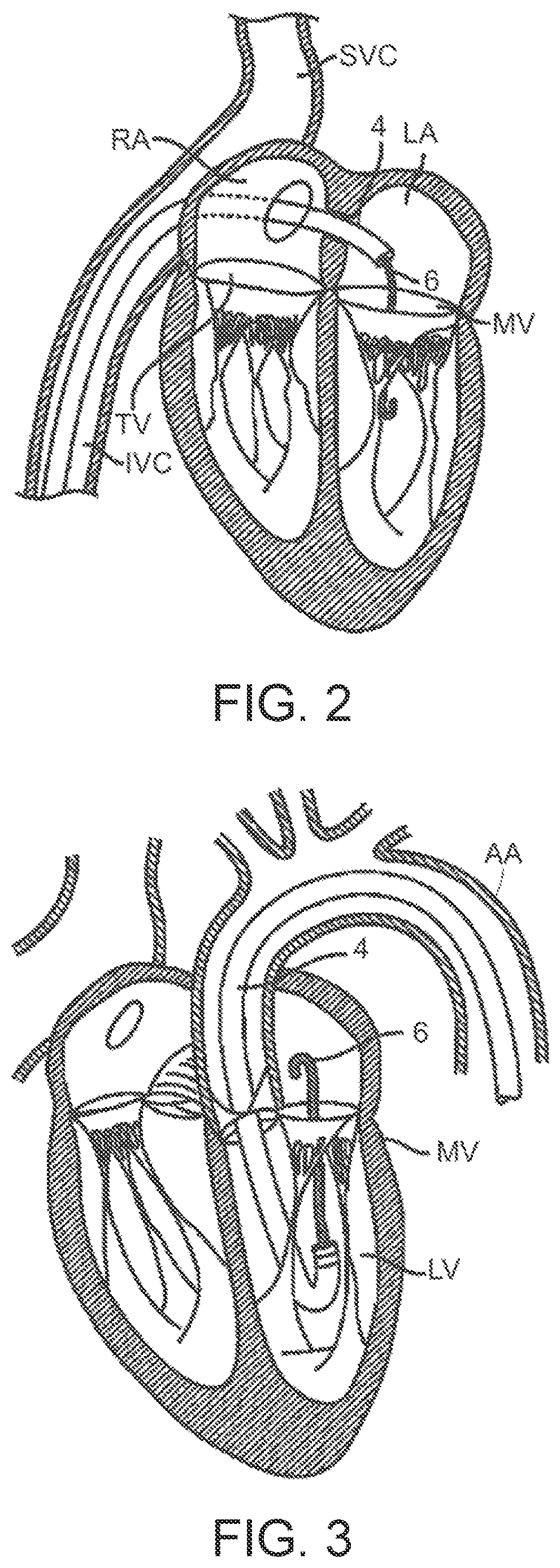 Patent US12611302 Figure 2 – Prosthetic heart valve device and associated systems and methods