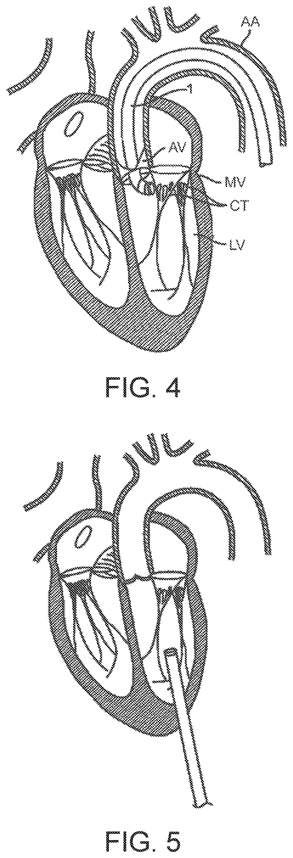 Patent US12611302 Figure 3 – Prosthetic heart valve device and associated systems and methods