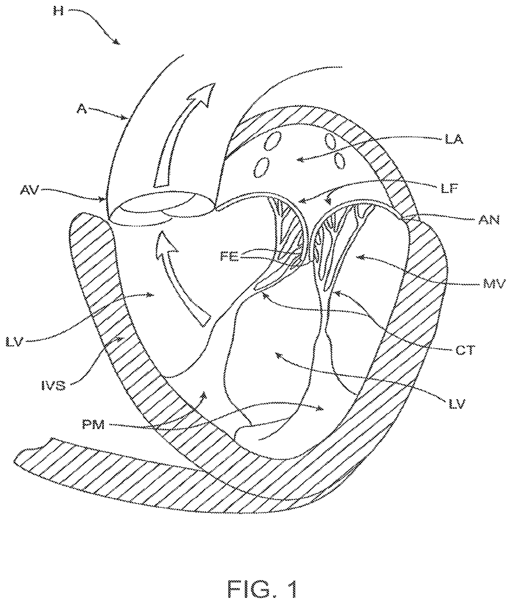 Patent US12611303 Figure 1 – Transcatheter mitral valve prosthesis