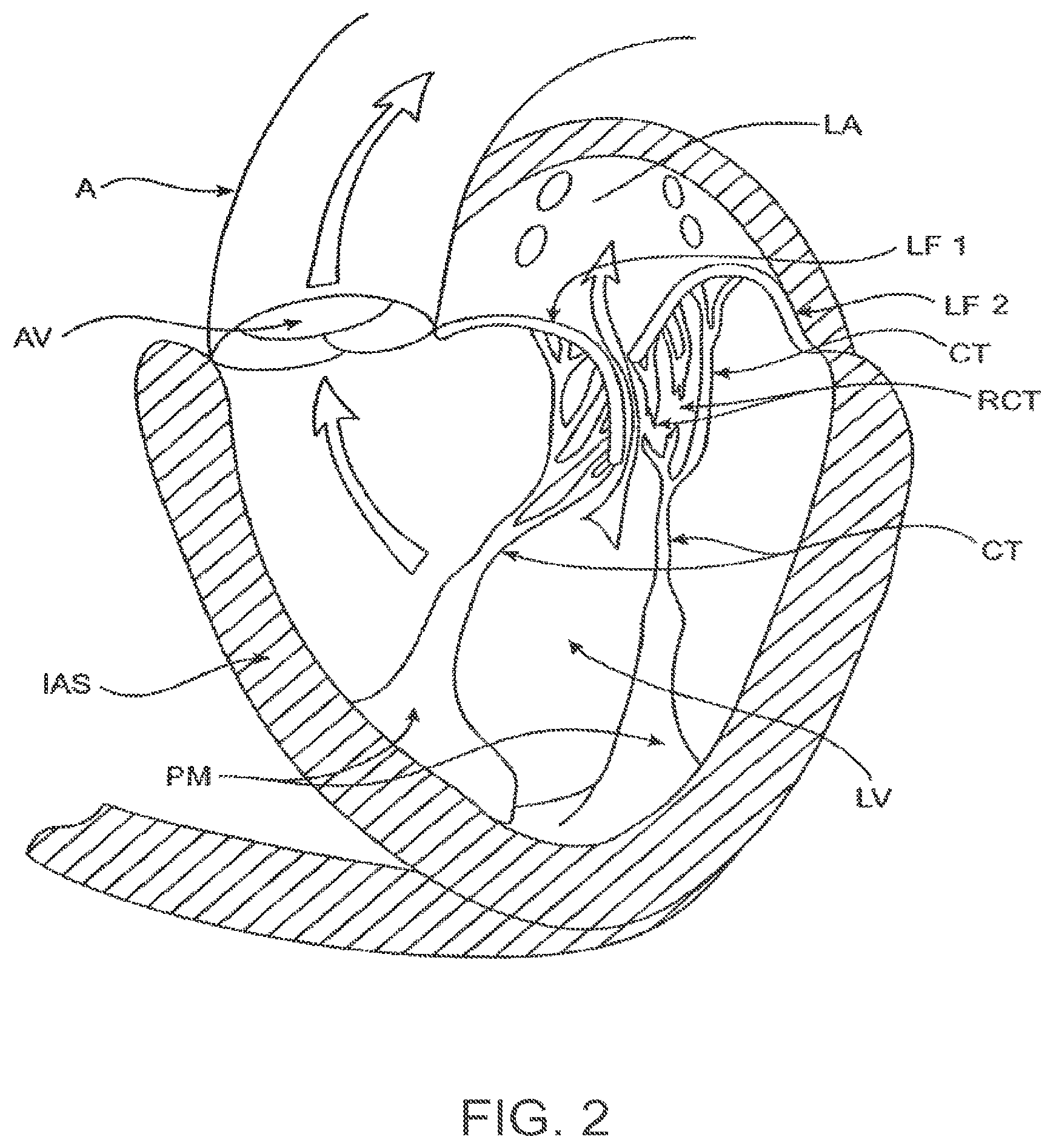 Patent US12611303 Figure 2 – Transcatheter mitral valve prosthesis