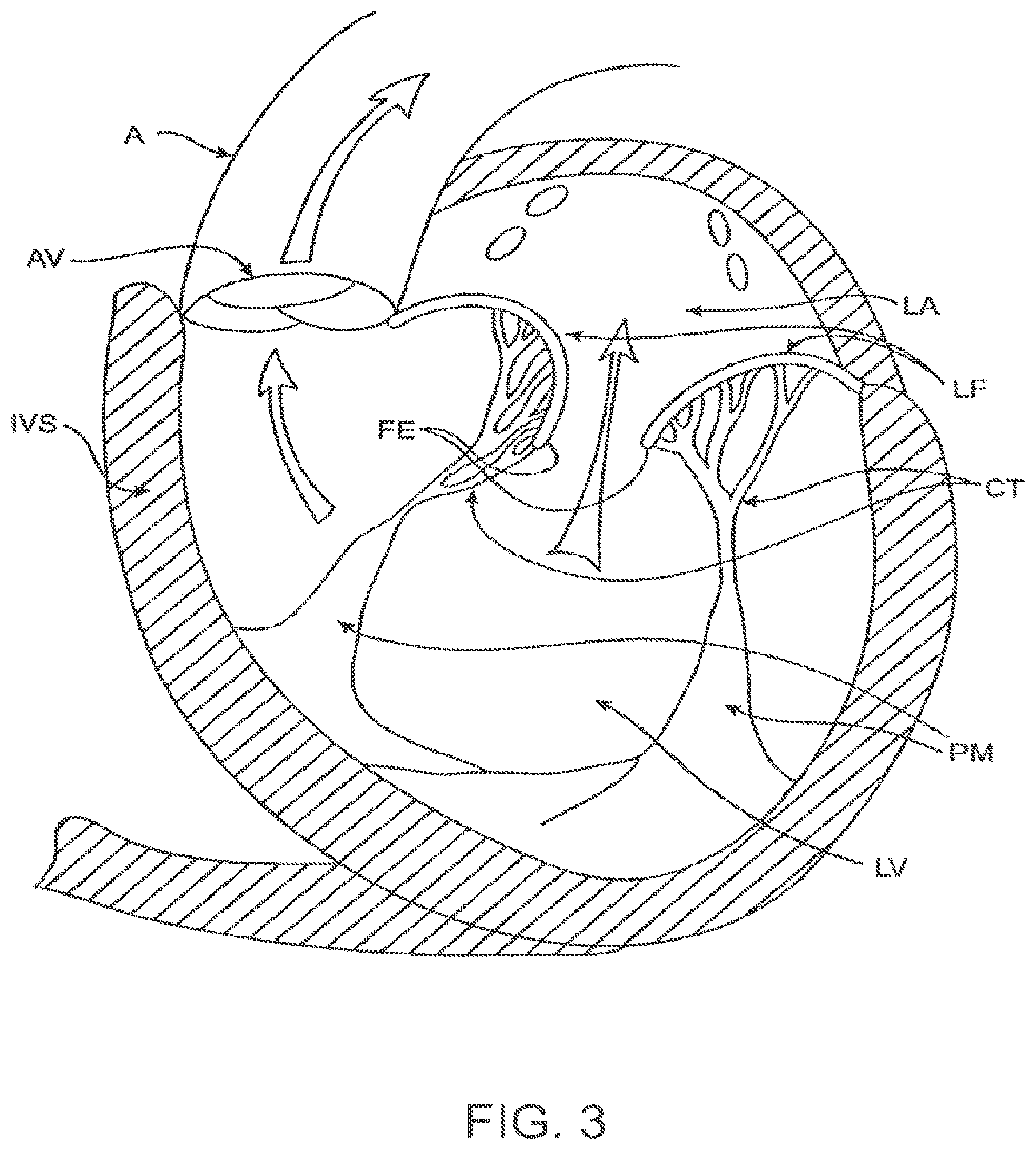Patent US12611303 Figure 3 – Transcatheter mitral valve prosthesis