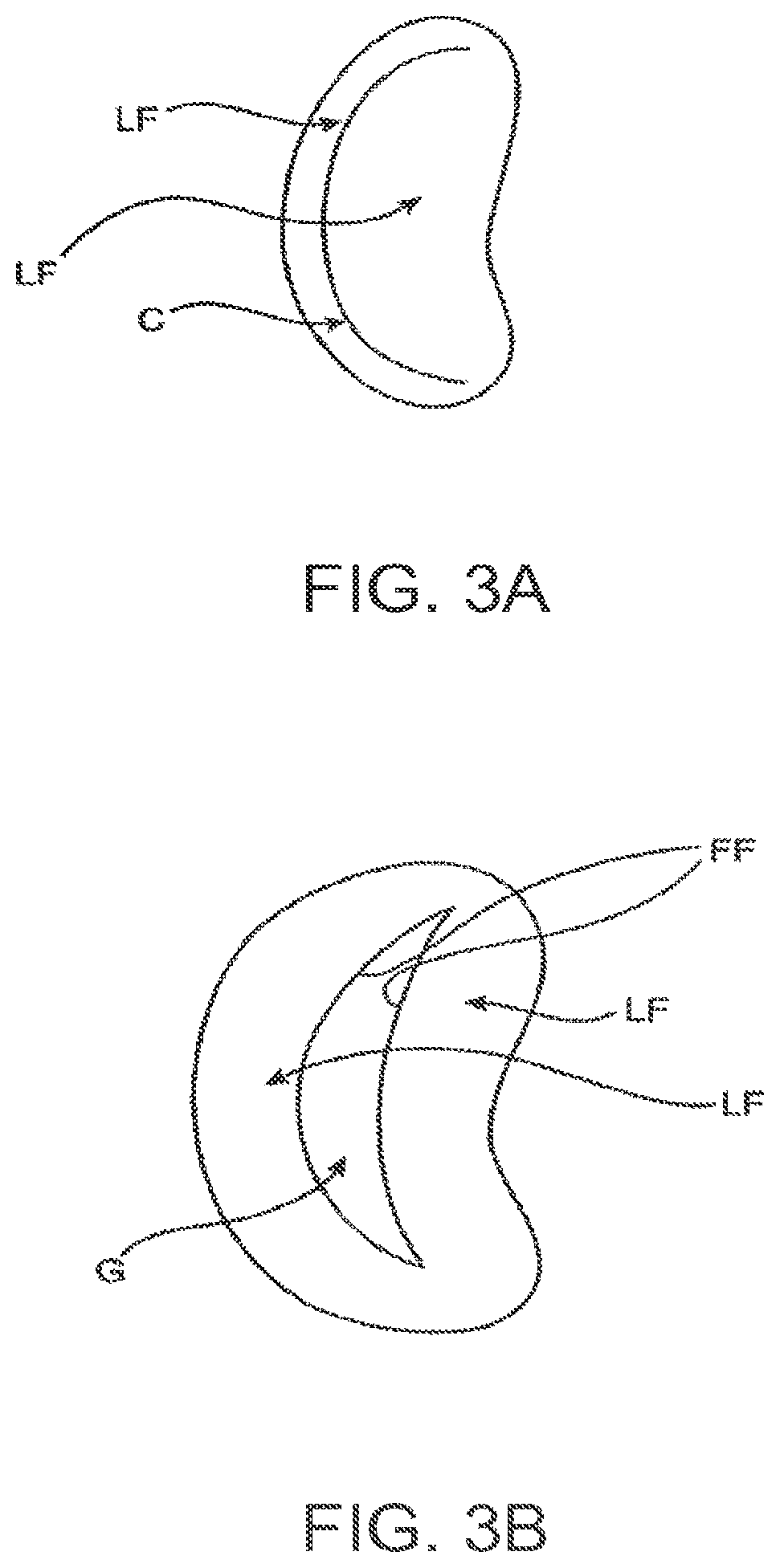 Patent US12611303 Figure 4 – Transcatheter mitral valve prosthesis