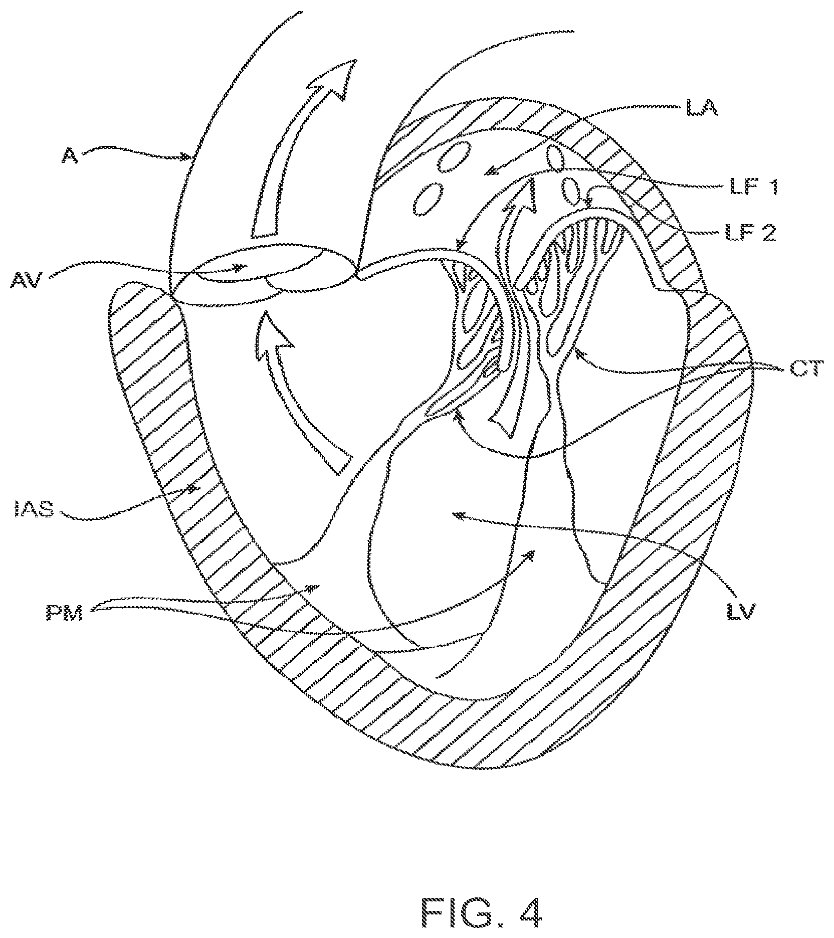 Patent US12611303 Figure 5 – Transcatheter mitral valve prosthesis