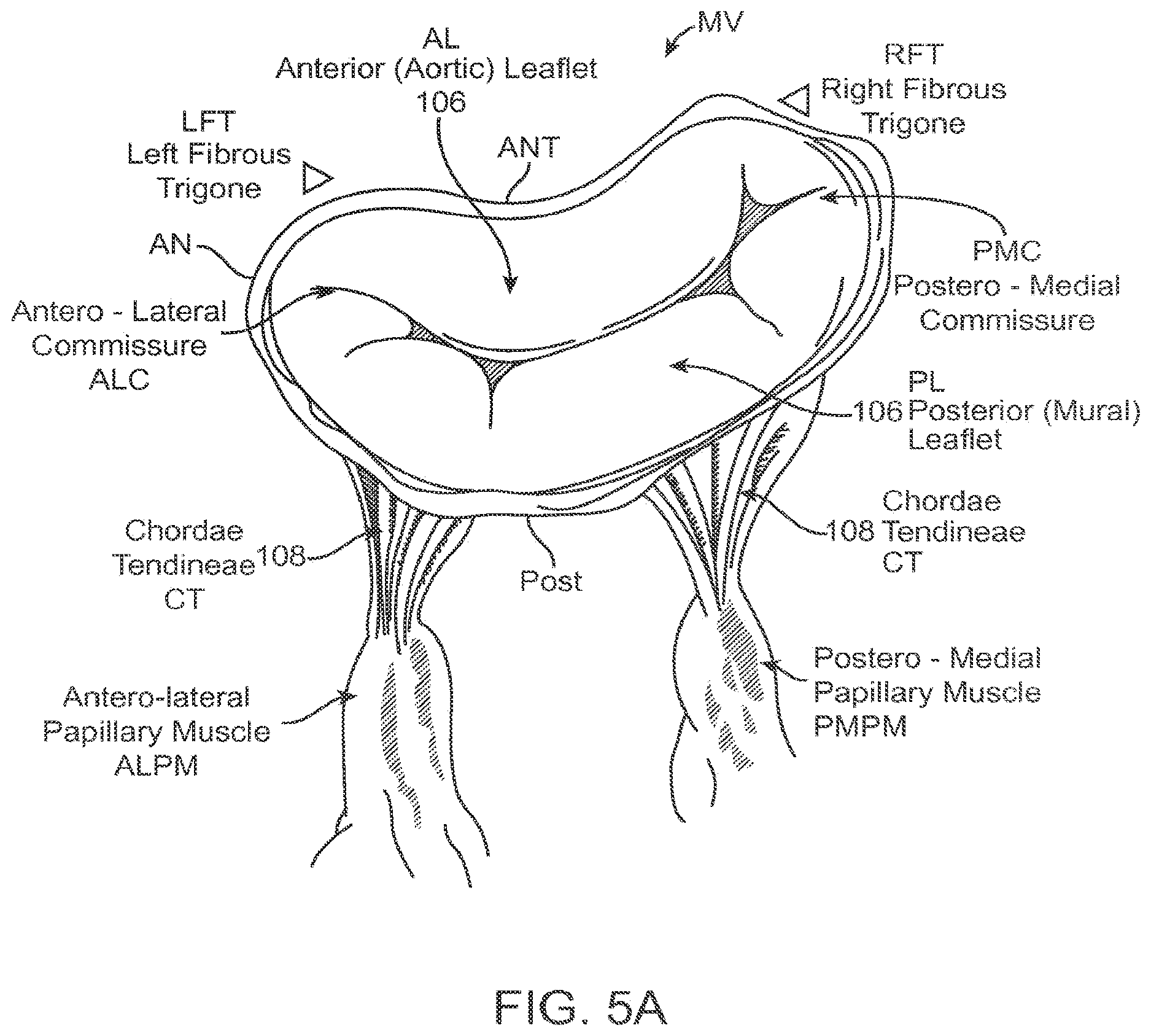 Patent US12611303 Figure 6 – Transcatheter mitral valve prosthesis