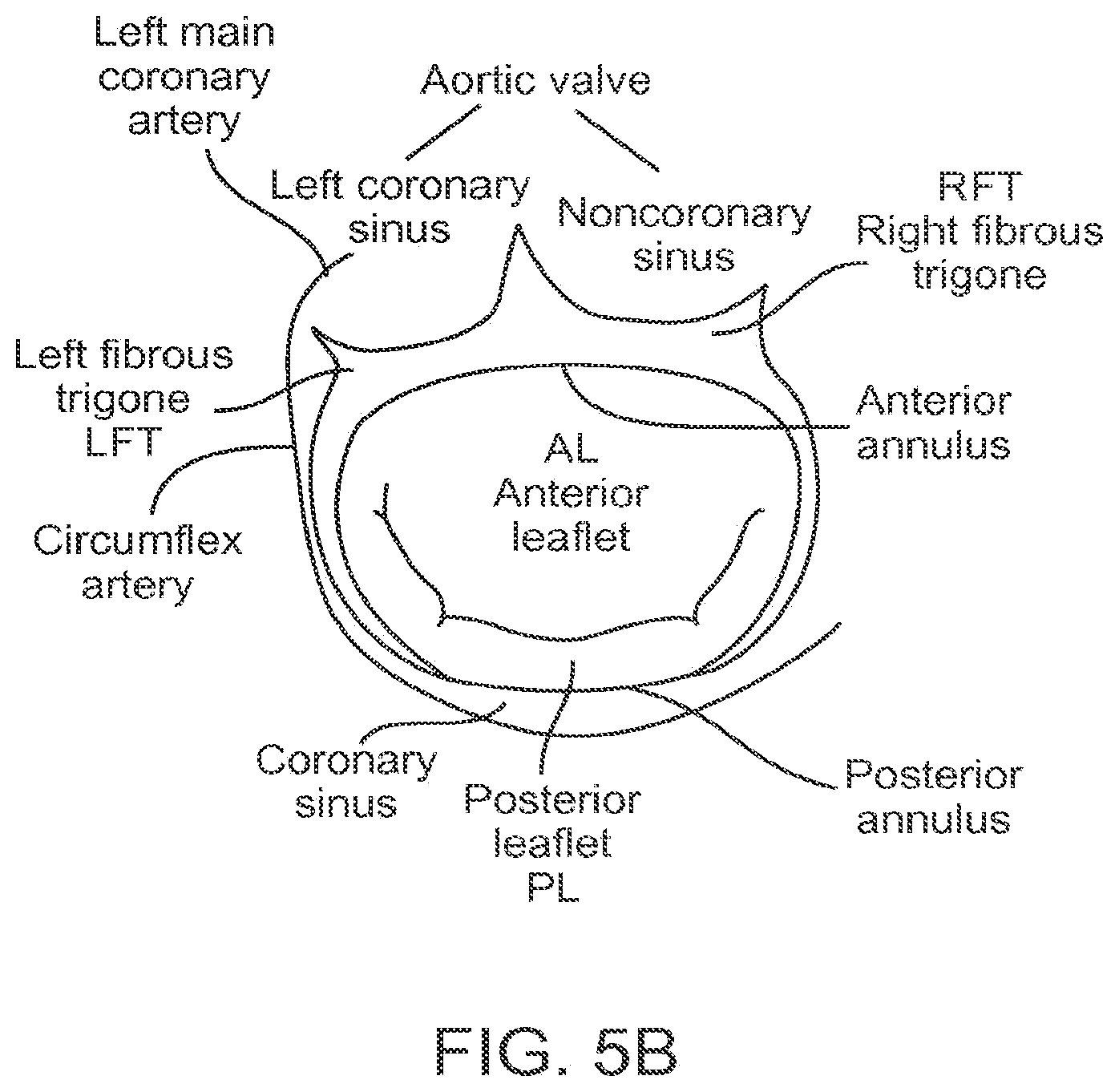 Patent US12611303 Figure 7 – Transcatheter mitral valve prosthesis