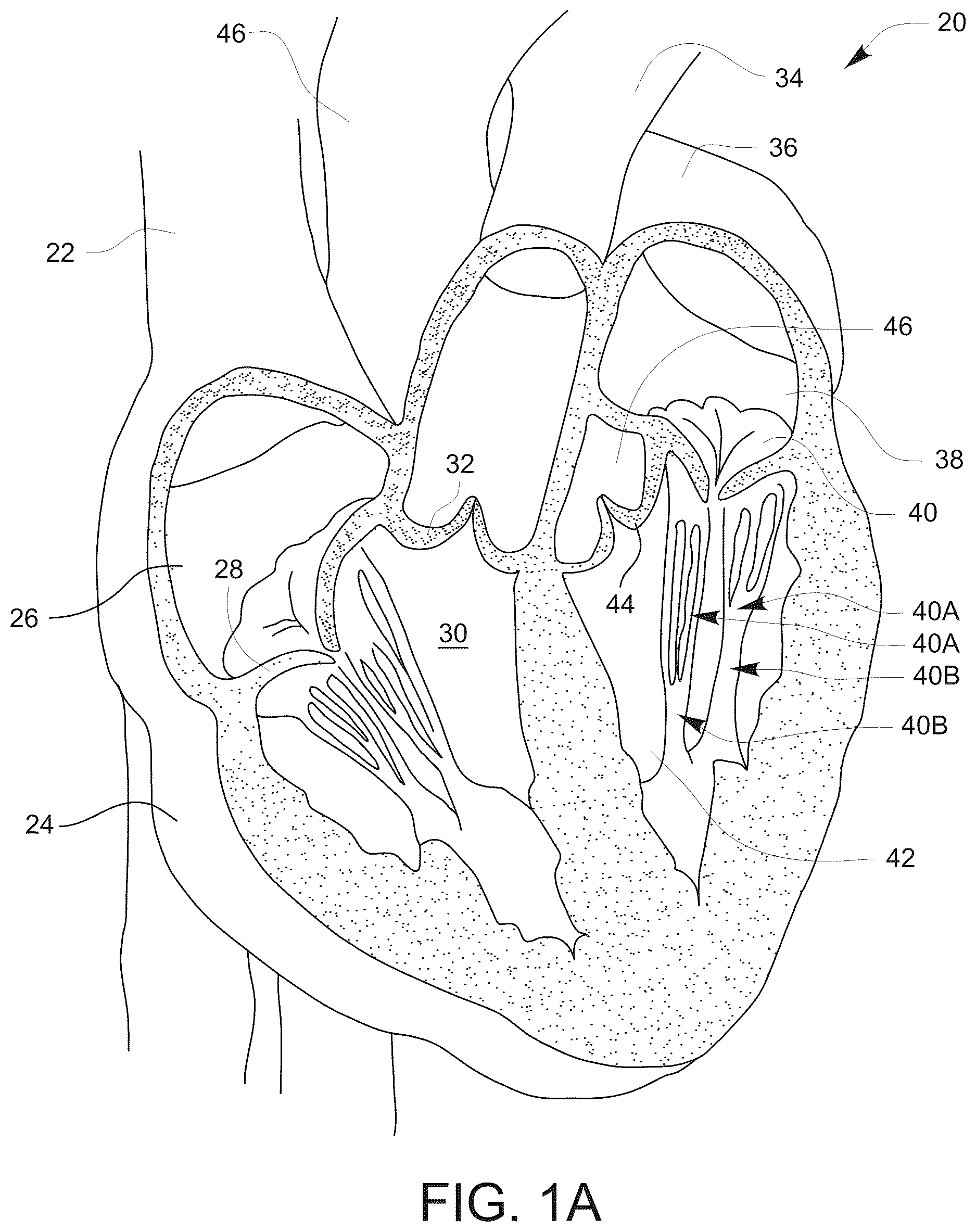 Patent US12611304 Figure 1 – Prosthetic incision device and methods thereof