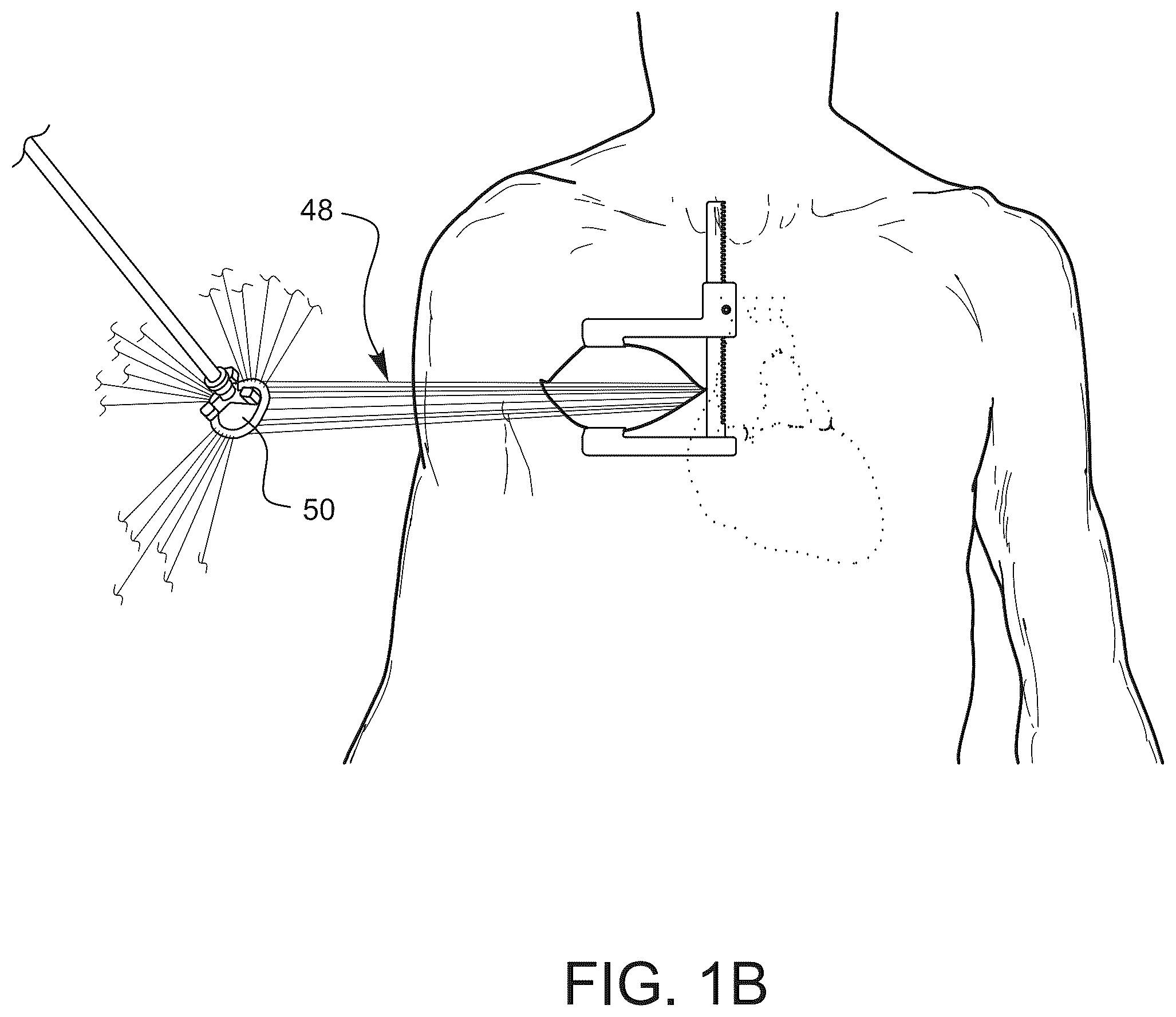 Patent US12611304 Figure 2 – Prosthetic incision device and methods thereof