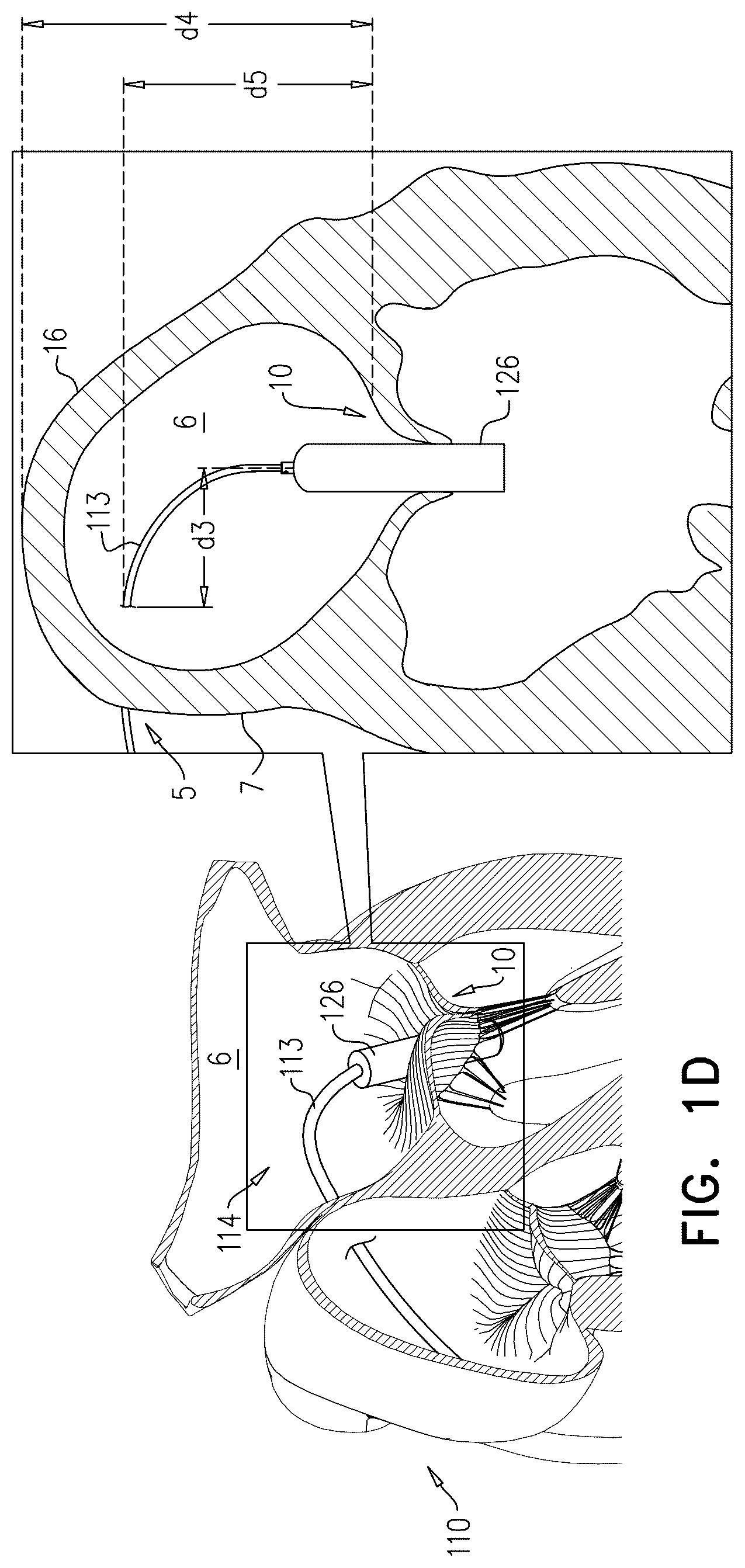 Patent US12611305 Figure 3 – Minimally-invasive delivery systems