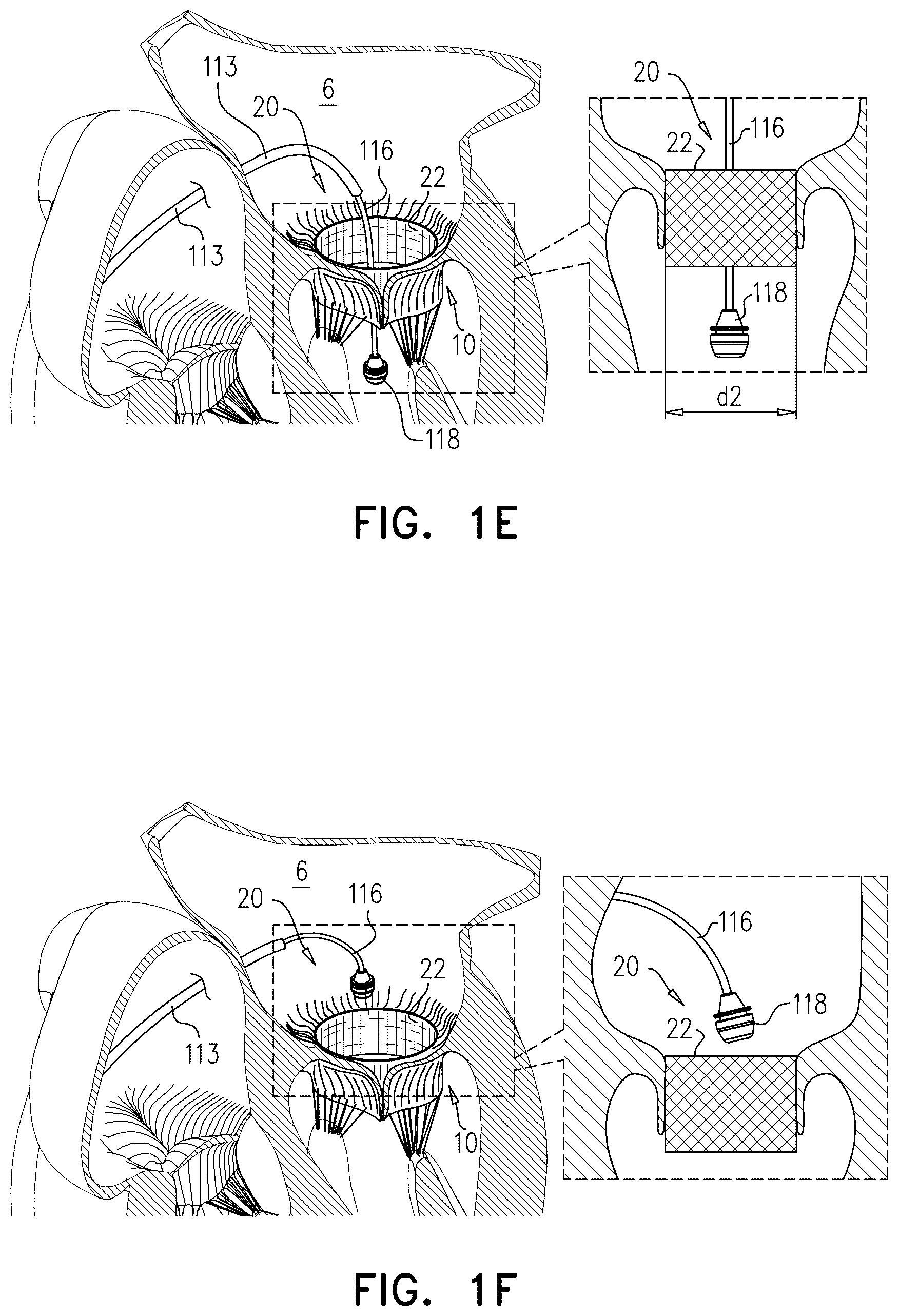 Patent US12611305 Figure 4 – Minimally-invasive delivery systems