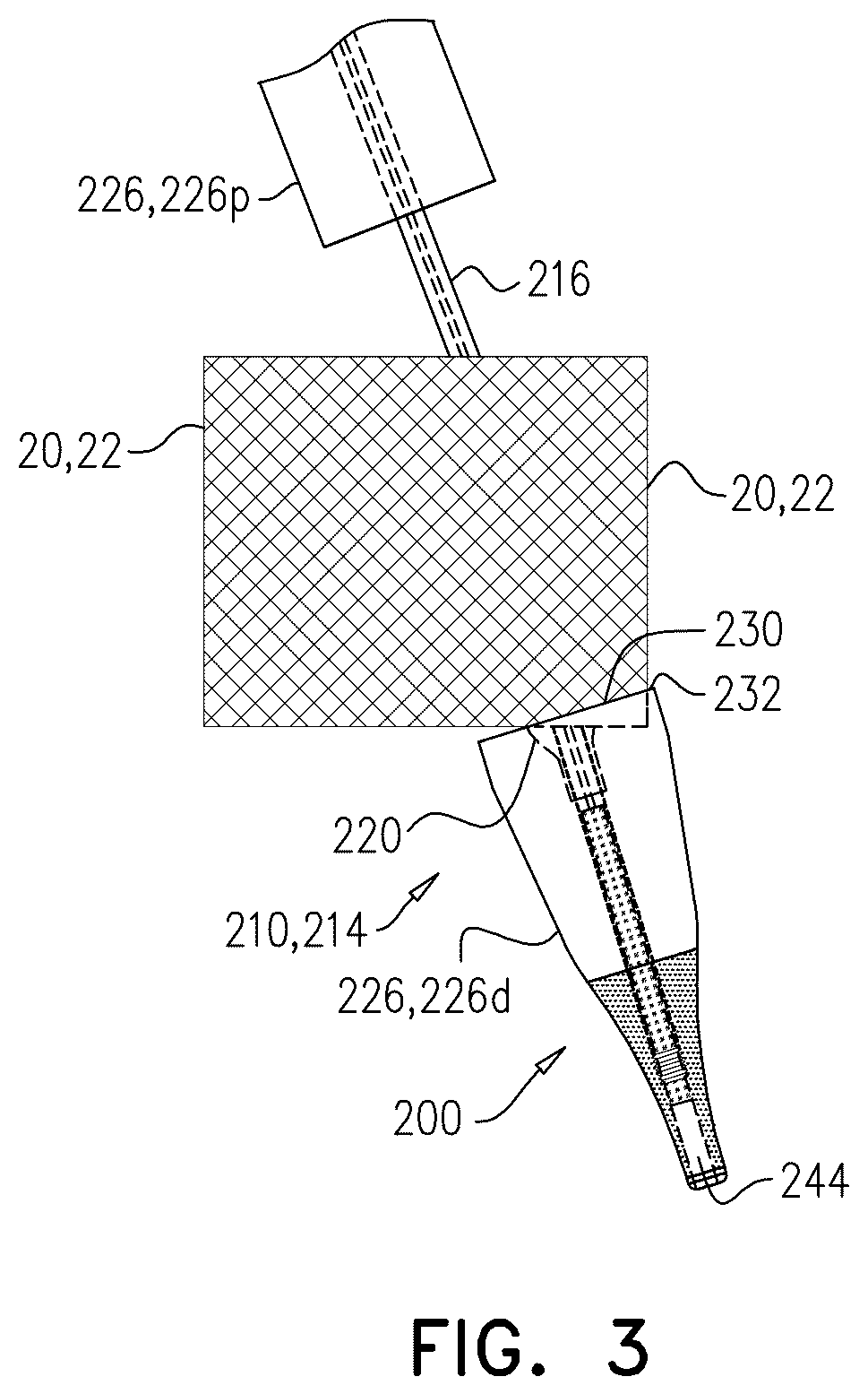 Patent US12611305 Figure 7 – Minimally-invasive delivery systems