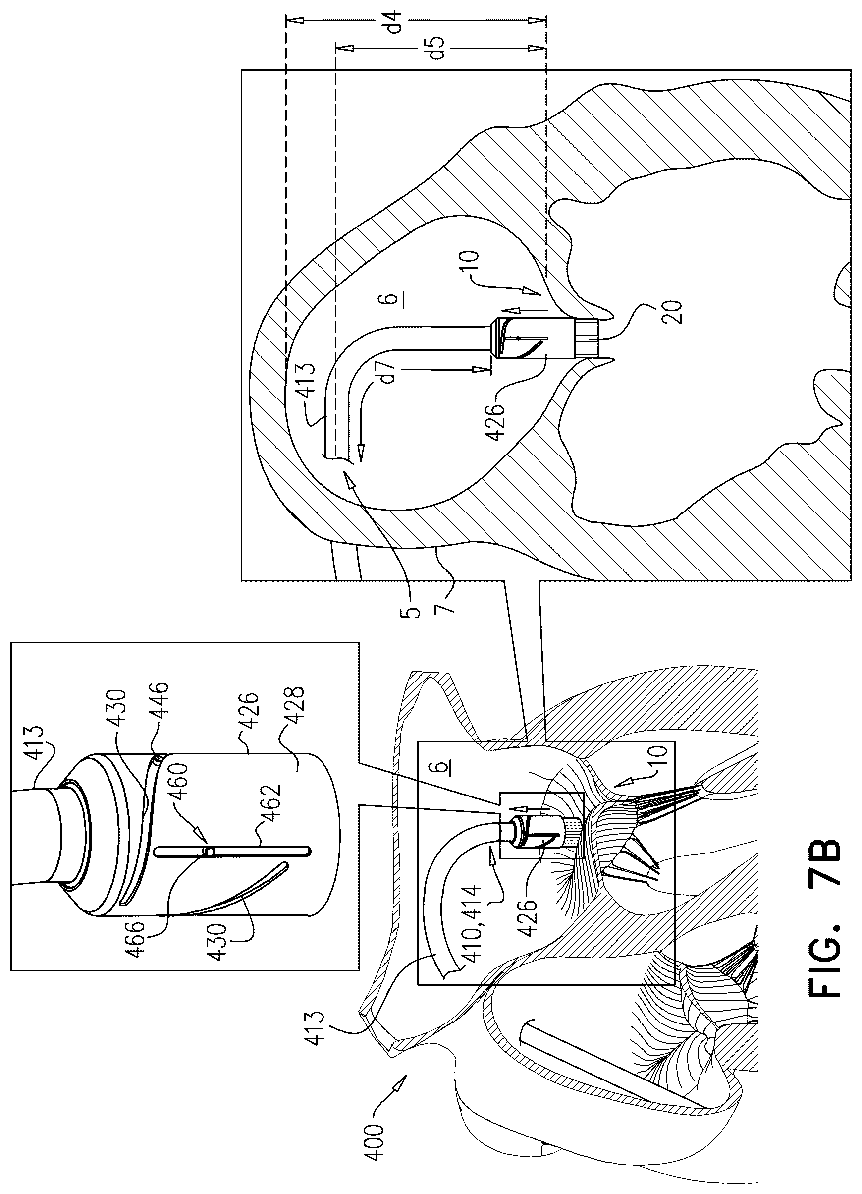 Patent US12611305 Figure 14 – Minimally-invasive delivery systems