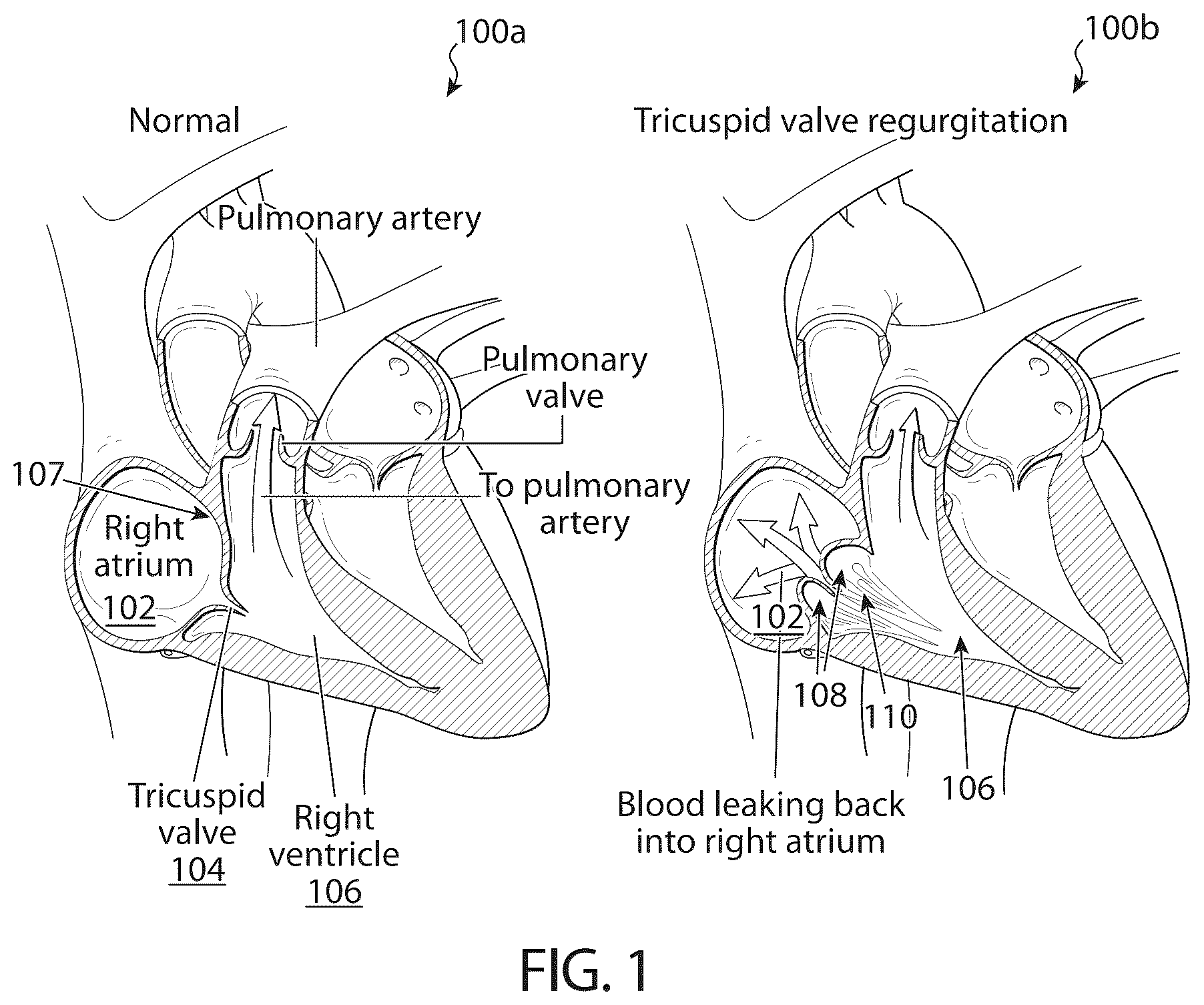 Patent US12611306 Figure 1 – Delivery systems and methods for prosthetic heart valve