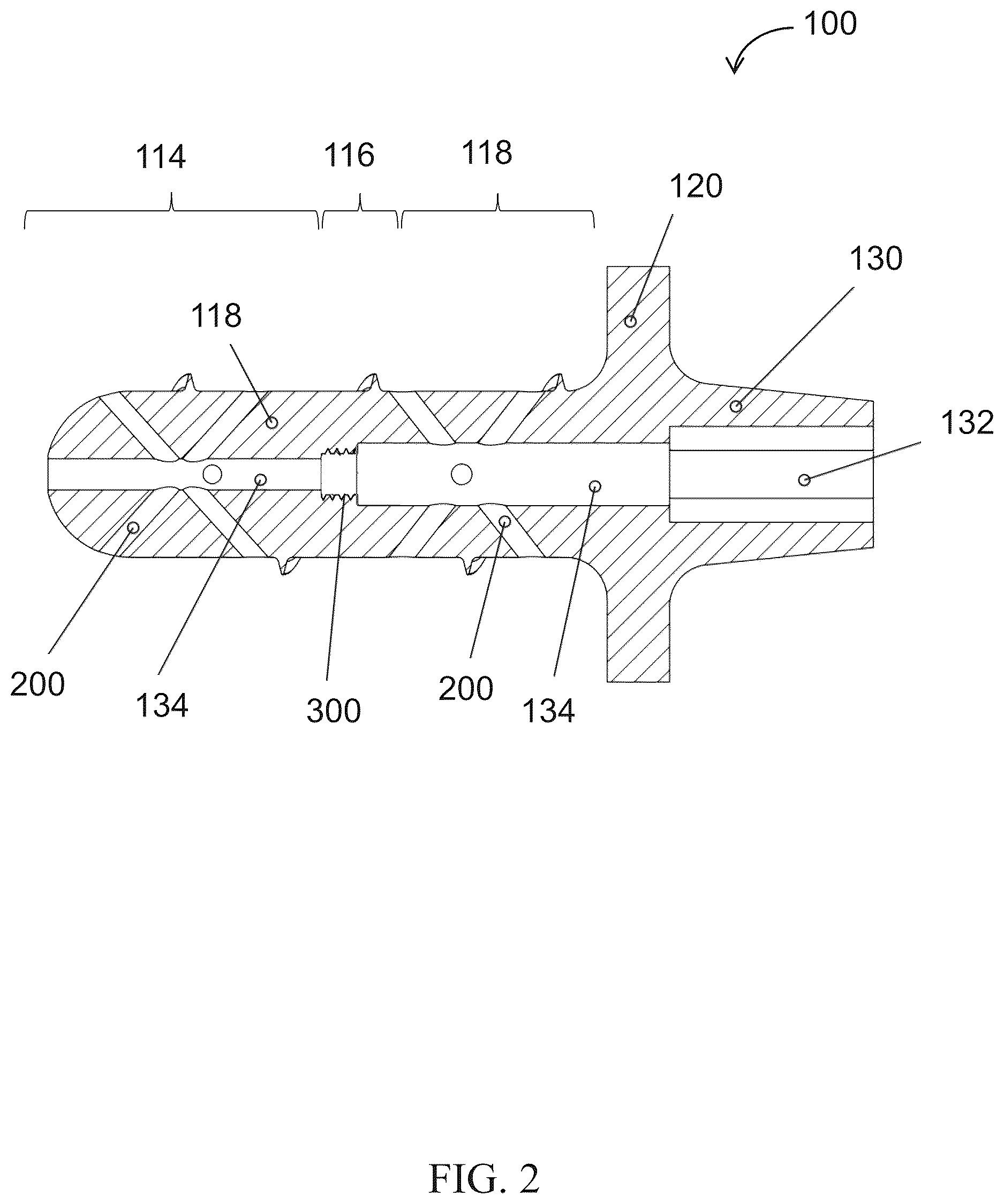 Patent US12611309 Figure 2 – Short implanted prosthesis and method of making same