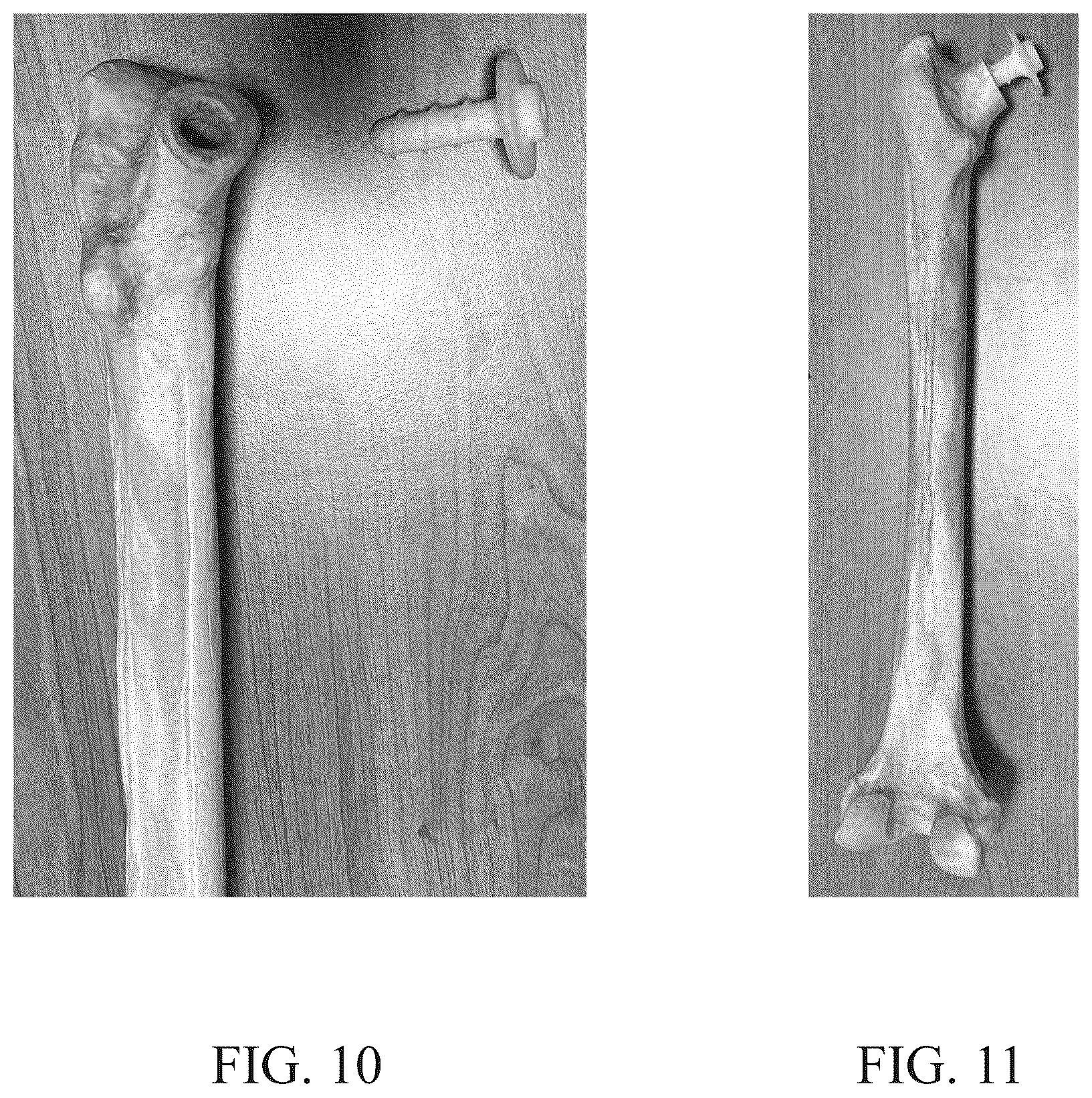 Patent US12611309 Figure 8 – Short implanted prosthesis and method of making same