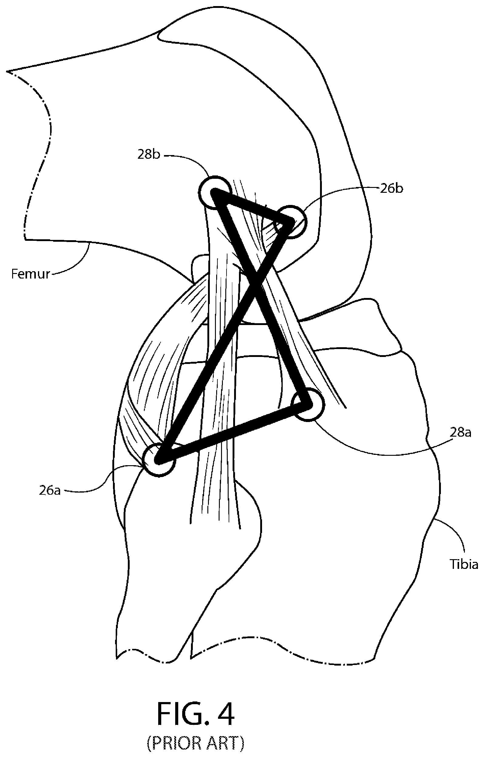 Patent US12611310 Figure 4 – Modular artificial knee system