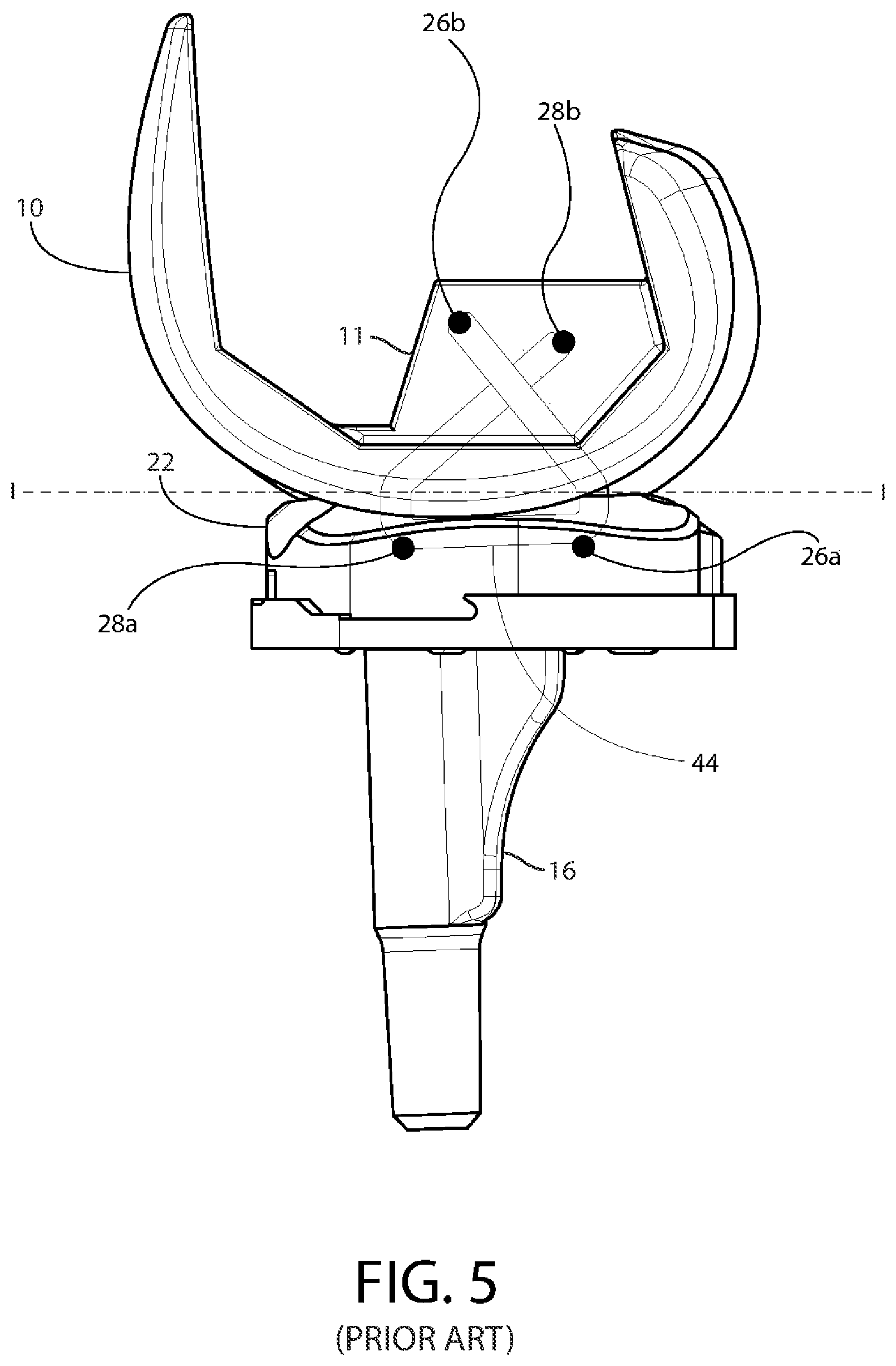 Patent US12611310 Figure 5 – Modular artificial knee system